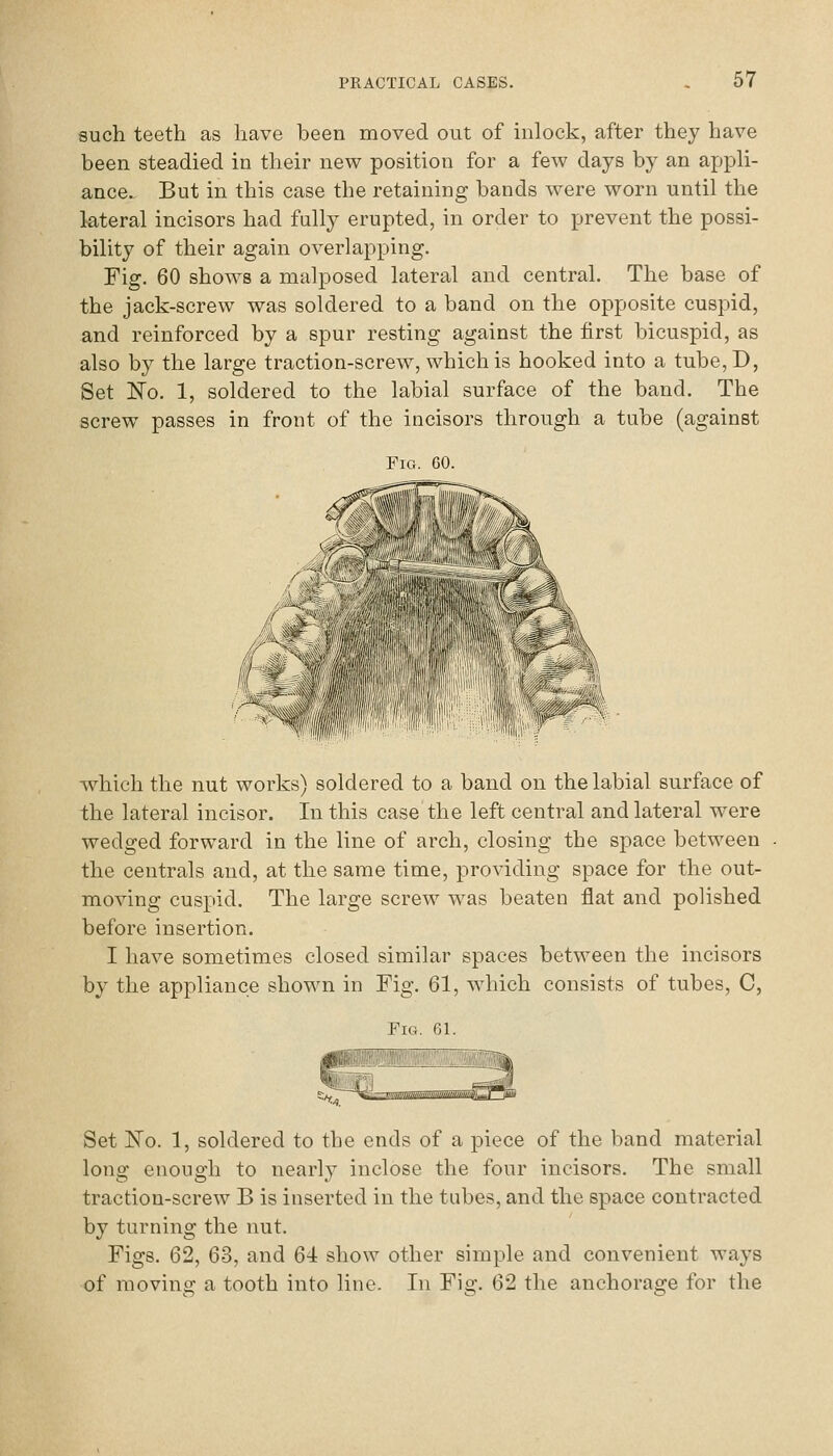 such teeth as have been moved out of inlock, after they have been steadied in their new position for a few days by an appli- ance. But in this case the retaining bands were worn until the lateral incisors had fully erupted, in order to prevent the possi- bility of their again overlapping. Fig. 60 shows a malposed lateral and central. The base of the jack-screw was soldered to a band on the opposite cuspid, and reinforced by a spur resting against the first bicuspid, as also by the large traction-screw, which is hooked into a tube, D, Set No. 1, soldered to the labial surface of the band. The screw passes in front of the incisors through a tube (against Fig. 60. w ' ■ 11,1,1 7 which the nut works) soldered to a band on the labial surface of the lateral incisor. In this case the left central and lateral were wedged forward in the line of arch, closing the space between the centrals and, at the same time, providing space for the out- moving cuspid. The large screw was beaten flat and polished before insertion. I have sometimes closed similar spaces between the incisors by the appliance shown in Fig. 61, which consists of tubes, C, Tig. 61. Set 'No. 1, soldered to the ends of a piece of the band material long enough to nearly inclose the four incisors. The small traction-screw B is inserted in the tubes, and the space contracted by turning the nut. Figs. 62, 63, and 64 show other simple and convenient ways of moving a tooth into line. In Fig. 62 the anchorage for the