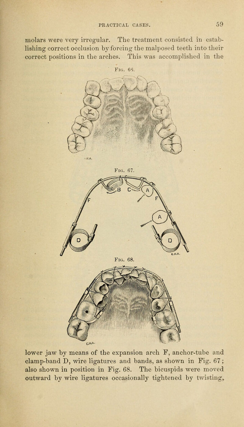 molars were very irregular. The treatment consisted in estab- lishing correct occlusion by forcing the malposed teeth into their correct positions in the arches. This was accomplished in the Fig. 66. ^^'-'M\ Fig. 67. lower jaw by means of the expansion arch F, anchor-tube and clamp-band D, wire ligatures and bands, as shown in Fig. 67; also shown in position in Fig. 68. The bicuspids were moved outward by wire ligatures occasionally tightened by twisting^