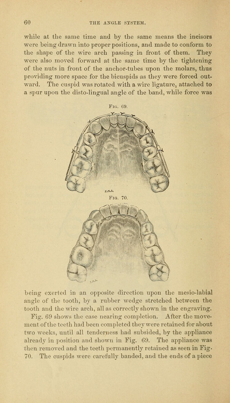 while at the same time and by the same means the incisors were being drawn into proper positions, and made to conform to the shape of the wire arch passing in front of them. They were also moved forward at the same time by the tightening of the nuts in front of the anchor-tubes upon the molars, thus providing more space for the bicuspids as they were forced out- ward. The cusj^id was rotated with a wire ligature, attached to a spur upon the disto-lingual angle of the band, while force was Fig. 69 f< r\mM Pig. 70. c;i\>- ^._A7 heing exerted in an opposite direction upon the mesio-labial angle of the tooth, by a rubber wedge stretched between the tooth and the -svire arch, all as correctly shown in the engraving. Fig. 69 shows the case nearhig completion. After the move- ment of the teeth had been completed they were retained for about two weeks, until all tenderness had subsided, by the appliance already in position and shown in Fig. 69. The appliance was then removed and the teeth permanently retained as seen in Fig. 70. The cuspids were carefully banded, and the ends of a piece