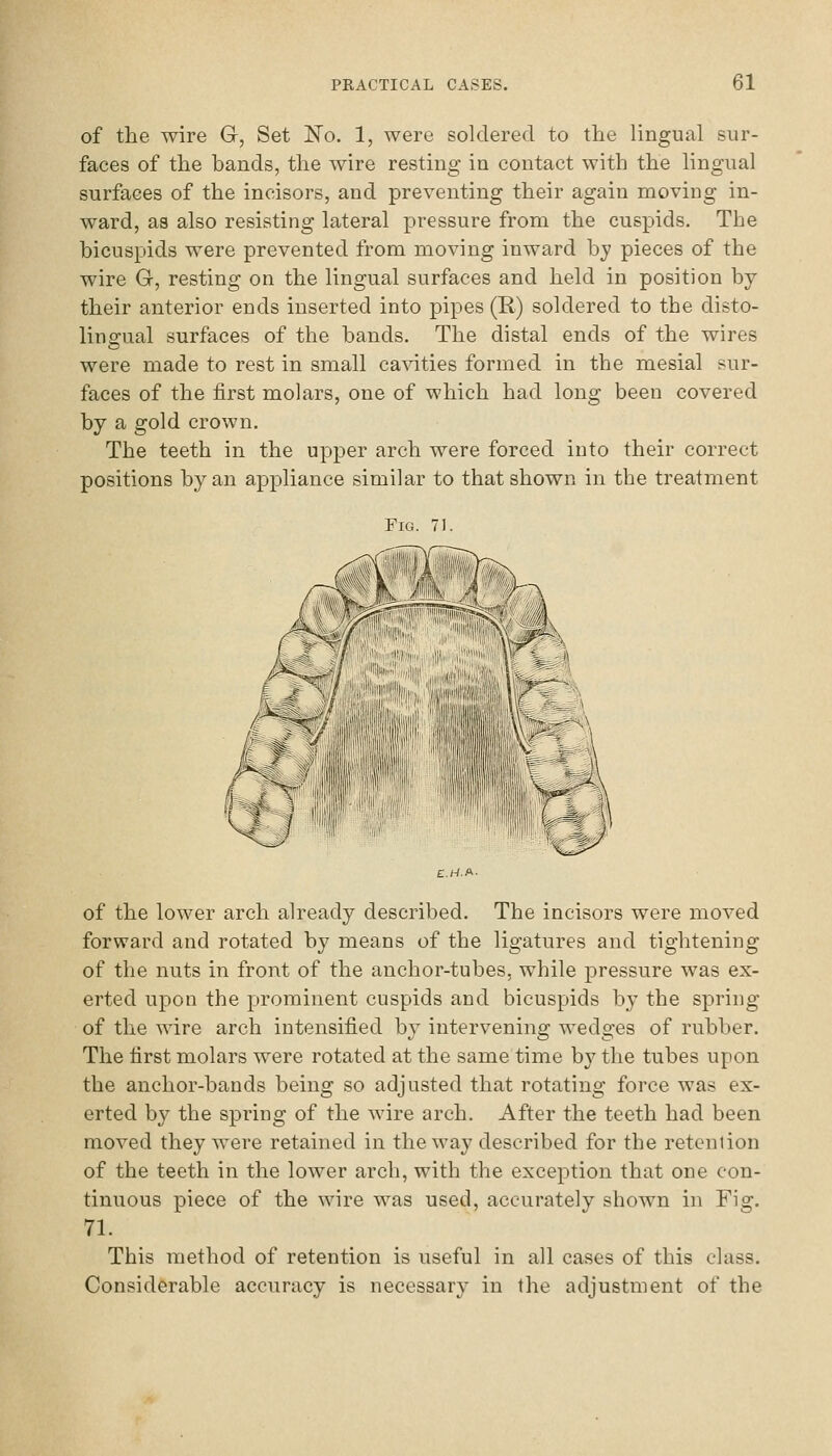 of the wire Gr, Set No. 1, were soldered to tlie lingual sur- faces of the bands, the wire resting in contact with the lingual surfaces of the incisors, and preventing their again moving in- ward, as also resisting lateral pressure from the cuspids. The bicuspids were prevented from moving inward by pieces of the wire G, resting on the lingual surfaces and held in position by their anterior ends inserted into pipes (R) soldered to the disto- lingual surfaces of the bands. The distal ends of the wires were made to rest in small cavities formed in the mesial sur- faces of the first molars, one of which had long been covered by a gold crown. The teeth in the upper arch were forced into their correct positions by an appliance similar to that shown in the treatment Fig. 71. '^ of the lower arch already described. The incisors were moved forward and rotated by means of the ligatures and tightening of the nuts in front of the anchor-tubes, while pressure was ex- erted upon the prominent cuspids and bicuspids by the spring of the wire arch intensified by intervening wedges of rubber. The first miolars were rotated at the same time by the tubes upon the anchor-bands being so adjusted that rotating force was ex- erted by the spring of the wire arch. After the teeth had been moved they were retained in the way described for the retention of the teeth in the lower arch, with the exception that one con- tinuous piece of the wire was used, accurately shown in Fig. 71. This method of retention is useful in all cases of this class. Considerable accuracy is necessary in the adjustment of the