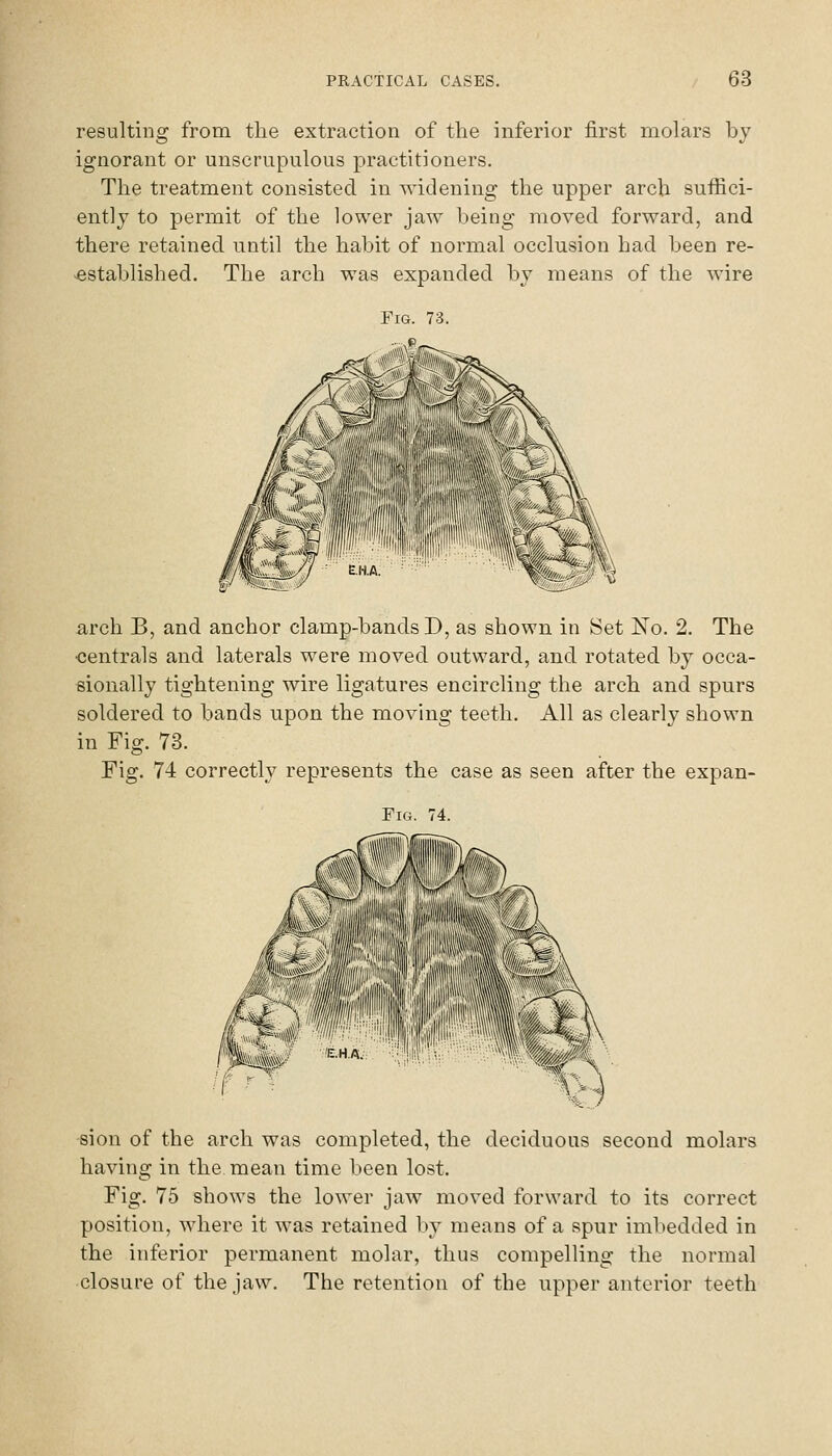 resulting from the extraction of the inferior first molars by ignorant or unscrupulous practitioners. The treatment consisted in widening the upper arch suffici- ently to permit of the lower jaw being moved forward, and there retained until the habit of normal occlusion had been re- -established. The arch was expanded by means of the wire arch B, and anchor clamp-bands D, as shown in Set No. 2. The •centrals and laterals were moved outward, and rotated by occa- sionally tightening wire ligatures encircling the arch and spurs soldered to bands upon the moving teeth. All as clearly shown in Fig. 73. Fig. 74 correctly represents the case as seen after the expan- FiG. 74. sion of the arch was completed, the deciduous second molars having in the mean time been lost. Fig. 75 shows the lower jaw moved forward to its correct position, where it was retained by means of a spur imbedded in the inferior permanent molar, thus compelling the normal closure of the jaw. The retention of the upper anterior teeth