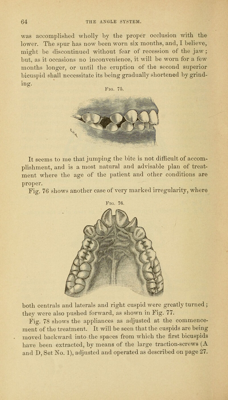 was accomplished wholly by the proper occlusion with the lower. The spur has now been worn six months, and, I believe, might be discontinued without fear of recession of the jaw; but, as it occasions no inconvenience, it will be worn for a few months longer, or until the eruption of the second superior bicuspid shall necessitate its being gradually shortened by grind- ing. Fig. 75. It seems to me that jumping the bite is not difficult of accom- plishment, and is a most natural and advisable plan of treat- ment where the age of the patient and other conditions are proper. Fig. 76 shows another case of very marked irregularity, where Fig. 76. both centrals and laterals and right cuspid were greatly turned ; they were also pushed forward, as shown in Fig. 77. Fig. 78 shows the appliances as adjusted at the commence- ment of the treatment. It will be seen that the cuspids are being moved backward into the spaces from which the first bicuspids have been extracted, by means of the large traction-screws (A and D, Set No. 1), adjusted and operated as described on page 27.