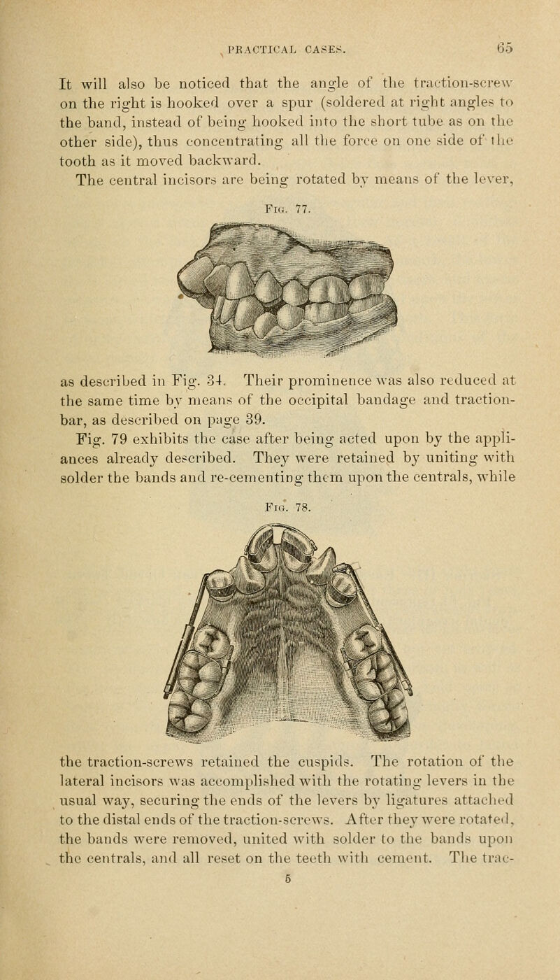 It will also be noticed that the angle of the traction-screw on the right is hooked over a spur (soldered at right angles to the band, instead of being hooked into the short tube as on the other side), thus concentrating all the force on one side of \hv tooth as it moved backward. The central incisors are being rotated by means of the lever, Fig. 77. as described in Fig. 34, Their prominence was also reduced at the same time by means of the occipital bandage and traction- bar, as described on page 39. Fig. 79 exhibits the case after being acted upon bj the appli- ances already described. They were retained by uniting with solder the bands and re-cementing them upon the centrals, while Fio. 78. the traction-screws retained the cuspids. The rotation of the lateral incisors was accomplished with the rotating levers in the usual way, securing the ends of the levers by ligatures attached to the distal ends of the traction-screws. After they were rotated, the bands were removed, united with solder to the bands upon the centrals, and all reset on the teeth with cement. The trac- 5
