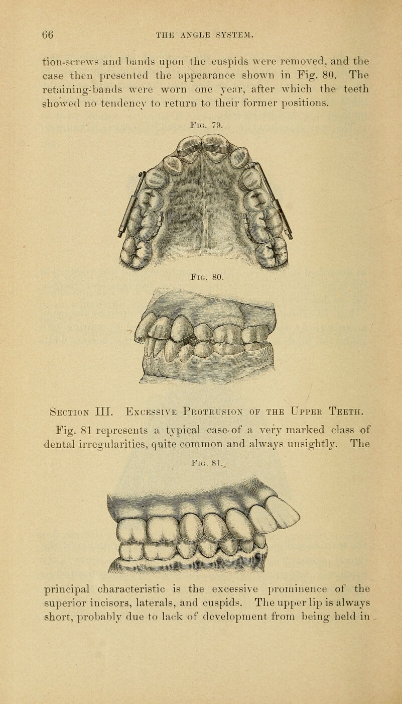 tion-screws and biuids upon the cuspids were removed, and the case then presented the appearance shown in Fig. 80. The retaining-bands were worn one year, after which the teeth showed no tendency to return to their former positions. Fig. 79. J5f* A^ ''I mx. V/'^ M Fig. 80. ^ Section III. Excessive Protrusion op the Upper Teeth. Fig. 81 represents a typical case of a very marked class of dental irregularities, quite common and always unsightly. The Fi(i. 81. principal characteristic is the excessive prominence of the superior incisors, laterals, and cuspids. The upper lip is always short, probably due to lack of development from being held in