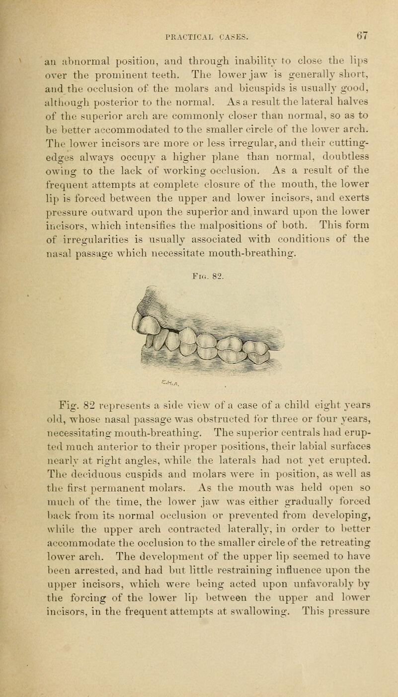 ail abnormal position, and through inability to close the lips over the prominent teeth. The lower jaw is generally short, and the occlusion of the molars and bicuspids is usually good, although posterior to the normal. Asa result the lateral halves of the superior arch are commonly closer than normal, so as to be better accommodated to the smaller circle of the lower arch. The lower incisors are more or less irregular, and their cutting- edges always occupy a higher plane than normal, doubtless owing to the lack of working occlusion. As a result of the frequent attempts at complete closure of the mouth, the lower lip is forced between the upper and lower incisors, and exerts pressure outward upon the superior and inward upon the lower incisors, which intensifies the malpositions of both. Tliis form of irregularities is usually associated with conditions of the nasal passage which necessitate mouth-breathing. Fig. 82. Fig. 82 represents a side view of a case of a child eight years old, whose nasal passage was obstructed for three or four years, necessitating mouth-breathing. The superior centrals had erup- ted much anterior to their proper positions, their labial surfaces nearly at right angles, while the laterals had not yet erupted. The deciduous cuspids and molars were in position, as well as the first permanent molars. As the mouth was held open so much of the time, the lower jaw was either gradually forced back from its normal occlusion or prevented from developing, while the upper arch contracted laterally, in order to better accommodate the occlusion to the smaller circle of the retreating lower arch. The development of the upper lip seemed to have been arrested, and had but little restraining influence upon the upper incisors, which were being acted upon unfavorably by the forcing of the lower lip l)etween the upper and lower incisors, in the frequent attempts at swallowing. This pressure