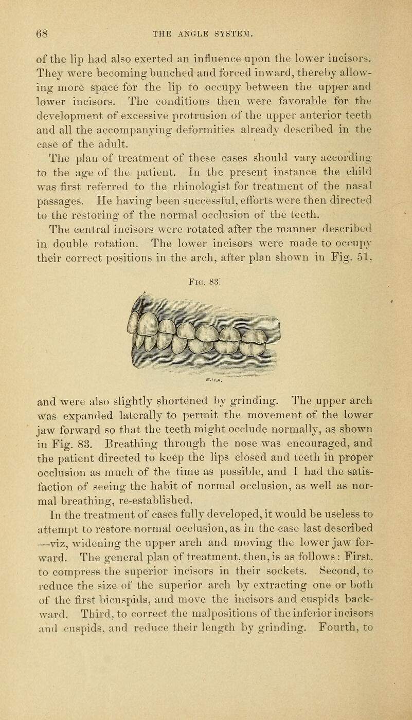 of the lip had also exerted an influence upon the lower incisors. They were becoming bunched and forced inward, thereby allow- ing more space for the lip to occupy between the upper and lower incisors. The conditions then were favorable for the development of excessive protrusion of the upper anterior teeth and all the accompanying deformities already described in the case of the adult. The plan of treatment of these cases should vary according to the age of the patient. In the present instance the child was first referred to the rhinologist for treatment of the nasal passages. He having been successful, eflbrts were then directed to the restoring of the normal occlusion of the teeth. The central incisors were rotated after the manner described in double rotation. The lower incisors were made to occupy their correct positions in the arch, after plan shown in Fig. 51, Fig. 83: and were also slightly shortened by grinding. The upper arch was expanded laterally to permit the movement of the lower jaw forward so that the teeth might occlude normally, as shown in Fig. 83. Breathing through the nose was encouraged, and the patient directed to keep the lips closed and teeth in proper occlusion as much of the time as possible, and I had the satis- faction of seeing the habit of normal occlusion, as well as nor- mal breathing, re-established. In the treatment of cases fully developed, it would be useless to attempt to restore normal occlusion, as in the case last described —viz, widening the upper arch and moving the lower jaw for- ward. The general plan of treatment, then, is as follows : First, to compress the superior incisors in their sockets. Second, to reduce the size of the superior arch by extracting one or both of the first Ijicuspids, and move the incisors and cuspids back- ward. Third, to correct the malpositions of the inferior incisors and cuspids, and reduce their length by grinding. Fourth, to