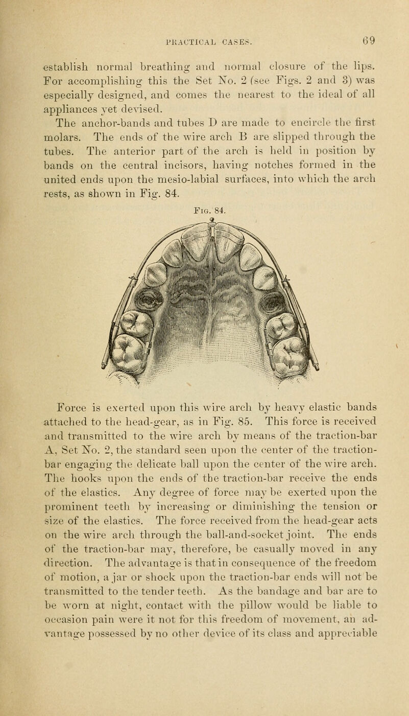 •establish normal breathing and normal closure of the lips. For accomplishing this the Set No. 2 (see Figs. 2 and 3) was especially designed, and comes the nearest to the ideal of all appliances yet devised. The anchor-bands and tubes D are made to encircle the first molars. The ends of the wire arch B are slipped tiirough the tubes. The anterior part of the arch is held in position by bands on the central incisors, having notches formed in the united ends upon the mesio-labial surfaces, into which the arch rests, as shown in Fig. 84. Fig. 84. Force is exerted upon this wire arch by heavy elastic bands attached to the head-gear, as in Fig. 85. This force is received iind transmitted to the wire arch by means of the traction-bar A, Set ISTo. 2, the standard seen upon the center of the traction- bar engaging the delicate ball upon the center of the wire arch. The hooks upon the ends of the traction-bar recei^-e the ends of the elastics. Any degree of force may be exerted upon the prominent teeth by increasing or diminishing the tension or size of the elastics. The force received from the head-gear acts on the wire arch through the ball-and-socket joint. The ends of the traction-bar may, therefore, be casually moved in any direction. The advantage is that in consequence of the freedom of motion, ajar or shock upon the traction-bar ends will not be transmitted to the tender teeth. As the bandage and bar are to be worn at night, contact with the pillow would be liable to occasion pain were it not for this freedom of movement, an ad- vantage possessed by no other device of its class and appreciable