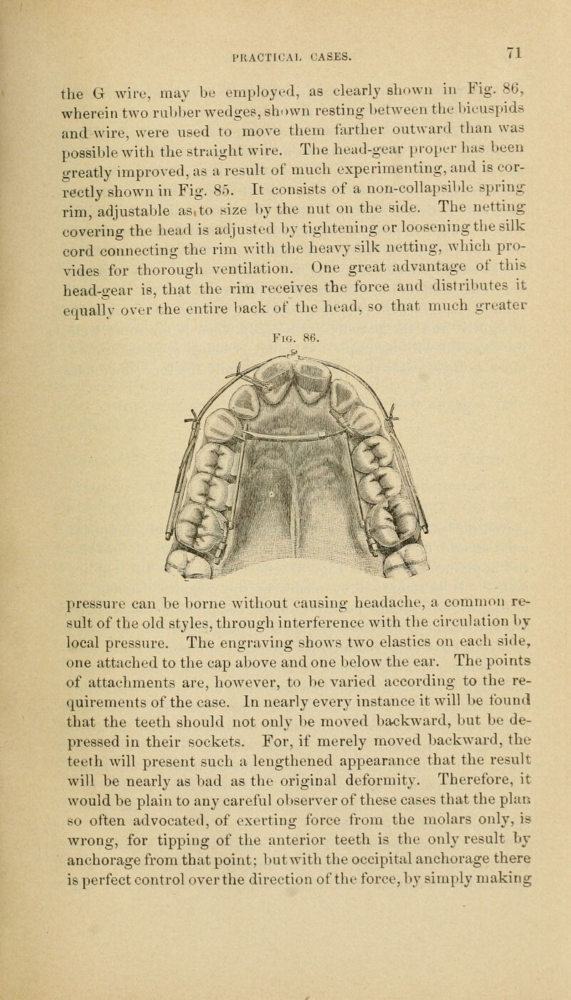 the G wire, may be employed, as clearly shown in Fig. 86, wherein two rubber wedges, shown resting l)etweon the bicuspids and wire, were used to move them farther outward than was possible with the straight wire. Tlie head-gear proper has been greatly improved, as a result of much experimenting, and is cor- rectly shown in Fig. 85. It consists of a non-collapsil)lc spring rim, adjustable as.to size l»y the nut on the side. The netting covering the head is adjusted by tightening or loosening the silk cord connecting the rim with the heavy silk netting, which pro- vides for thorough ventilation. One great advantage of this head-gear is, that the rim receives the force and distributes it equally over the entire l)ack of the head, so that much greater pressure can be borne without causing headache, a common re- sult of the old styles, through interference with the circulation hj local pressure. The engraving shows two elastics on each side, one attached to the cap above and one below the ear. The points of attachments are, however, to be varied according to the re- quirements of the case. In nearly every instance it will be found that the teeth should not only be moved backward, but be de- pressed in their sockets. For, if merely moved backward, the teeth will present such a lengthened appearance that the result will be nearly as bad as the original deformity. Therefore, it would be plain to any careful observer of these cases that the plan so often advocated, of exerting force from the molars only, is wrong, for tipping of the anterior teeth is the only result by anchoi-age from that point; but with the occipital anchorage there is perfect control over the direction of the force, by simply making