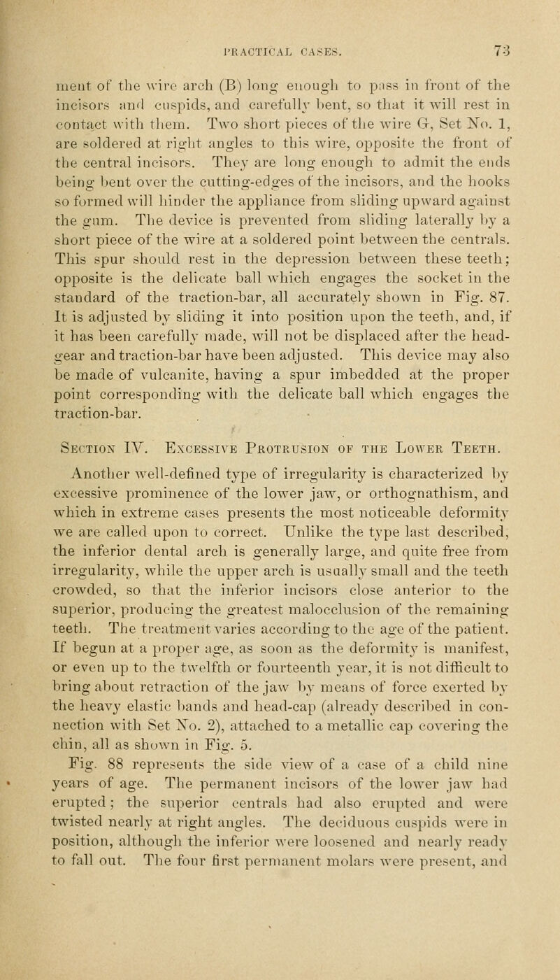 nietit of the wire arch (B) long enough to p;iss in front of the incisors find cuspids, and carefully hent, so that it will rest in contact with them. Two short pieces of the wire G, Set No. 1, are soldered at right angles to this wire, opposite the front of tlie central incisors. They are long enough to admit the ends being l)ent over the cutting-edges of the incisors, and the hooks so formed, will hinder the appliance from sliding upward against the gum. The device is prevented from sliding laterally l)y a short piece of the wire at a soldered point between the centrals. This spur should rest in the depression between these teeth; opposite is the delicate ball which engages the socket in the standard of the traction-bar, all accurately shown in Fig. 87. It is adjusted by sliding it into position upon the teeth, and, if it has been carefully made, will not be displaced after the head- gear and traction-bar have been adjusted. This device may also be made of vulcanite, having a spur imbedded at the proper point corresponding with the delicate ball which engages the traction-bar. Section 1A^. Excessive Protrusion of the Lower Teeth. Another well-defined type of irregularity is characterized by excessive prominence of the lower jaw, or orthognathism, and which in extreme cases presents the most noticeable deformity w^e are called upon to correct. Unlike the type last described, the inferior dental arcli is generally large, and quite free from irregularity, while the upper arch is usually small and the teeth crowded, so that the inferior incisors close anterior to the superior, producing the greatest malocclusion of the remaining teeth. The treatment varies according to the age of the patient. If begun at a proper age, as soon as the deformity is manifest, or even up to the twelfth or fourteenth year, it is not difficult to bring about retraction of the jaw by means of force exerted by the heavy elastic l)ands and head-cap (already described in con- nection with Set Xo. 2), attached to a metallic cap covering the chin, all as shown in Fig. 5. Fig. 88 represents the side view of a case of a child nine years of age. The permanent incisors of the lower jaw had erupted; the superior centrals had also erupted and were twisted nearh' at right angles. The deciduous cuspids were in position, although the inferior were loosened and nearly ready to fall out. The four first permanent molars were present, and