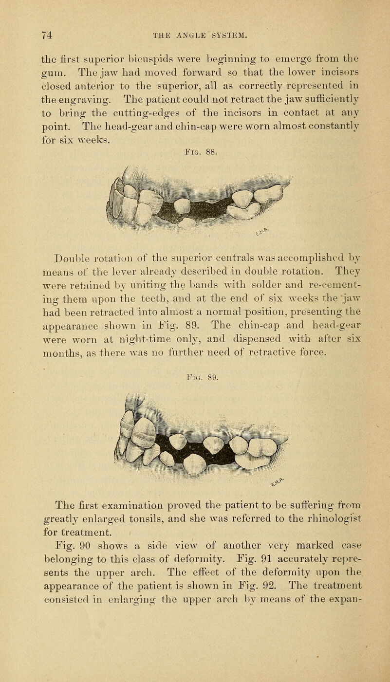 the first superior bicuspids were beginning to emerge from the gum. The jaw had moved forward so that the lower incisors closed anterior to the superior, all as correctly represented in the engraving. The patient could not retract the jaw sufficiently to bring the cutting-edges of the incisors in contact at any point. The head-gear and chin-cap were worn almost constant!}^ for six weeks. Fig. 88: Double rotation of the superior centrals was accomplished by means of the lever already described in double rotation. They were retained by uniting the bands with solder and re-cement- ing them upon the teeth, and at the end of six weeks the jaw had been retracted into almost a normal position, presenting the appearance shown in Fig. 89. The chin-cap and head-gear were worn at night-time only, and dispensed with after six months, as there was no further need of retractive force. Fig. 89. The first examination proved the patient to be suffering from greatly enlarged tonsils, and she was referred to the rhinologist for treatment. Fig. 90 shows a side view of another very marked case belonging to this class of deformity. Fig. 91 accurately repre- sents the upper arch. The effect of the deformity npon the appearance of the patient is shown in Fig. 92. The treatment consisted in enlarging the upper arch by means of the expan-