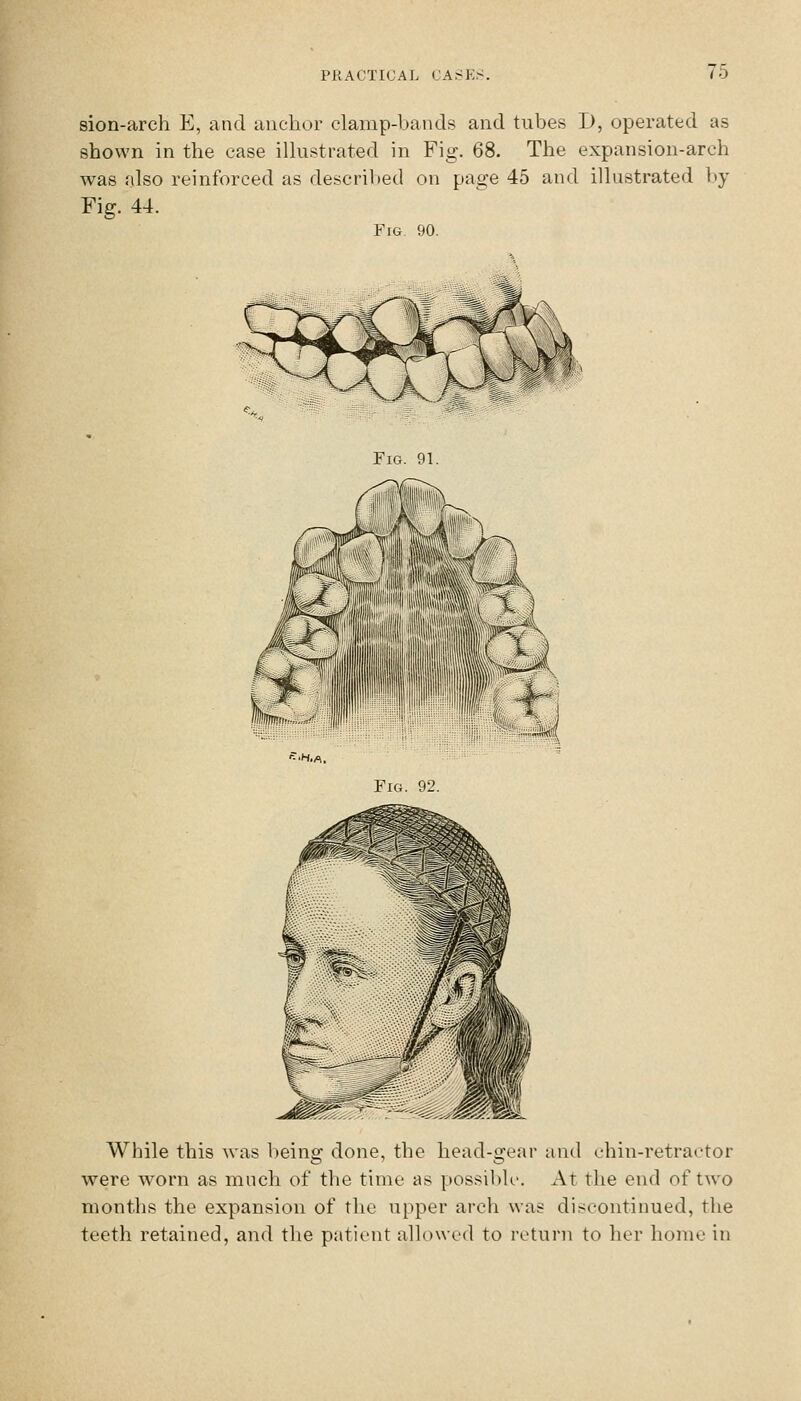 sion-arch E, and anchor clamp-bands and tubes D, operated as shown in the case ilkistrated in Fig. 68. The expansion-arch was also reinforced as described on page 45 and illustrated by Fig. 44. Fig 90. Fig. 91. •H.A. Fig. 92. While this was V)eing done, the head-gear and chin-retractor were worn as much of the time as possible. At the end of two months the expansion of the upper arch was discontinued, the teeth retained, and the patient allowed to return to her home in