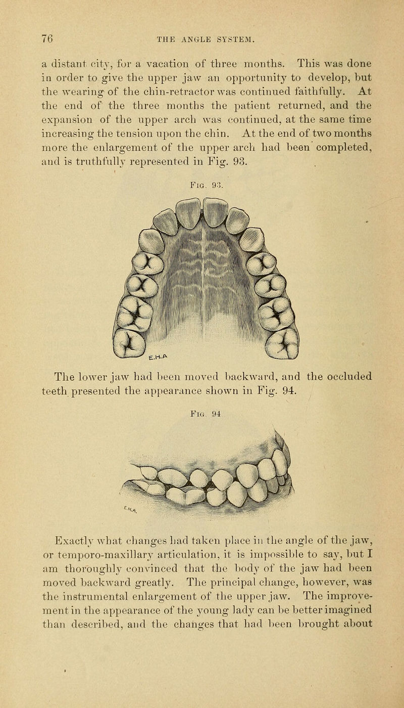 a distant city, for a vacation of three months. This was done in order to give the upper jaw an opportunity to develop, but the wearing of the chin-retractor was continued faithfully. At the end of the three months the patient returned, and the expansion of the upper arch was continued, at the same time increasing the tension upon the chin. At the end of two months more the enlargement of the upper arch had been completed, and is truthfully represented in Fig. 93. Fig. 93. The lower jaw had been moved backward, and the occluded teeth presented the appearance shown in Fig. 94. Fig, 94 Exactly what changes had taken phice in the angle of the jaw, or temporo-maxillary articulation, it is impossible to say, but I am thoroughly convinced that the body of the jaw had been moved backward greatly. The principal change, however, was the instrumental enlargement of the upper jaw. The improve- ment in the appearance of the young lady can Ije better imagined than described, and the changes that had l)een brought about
