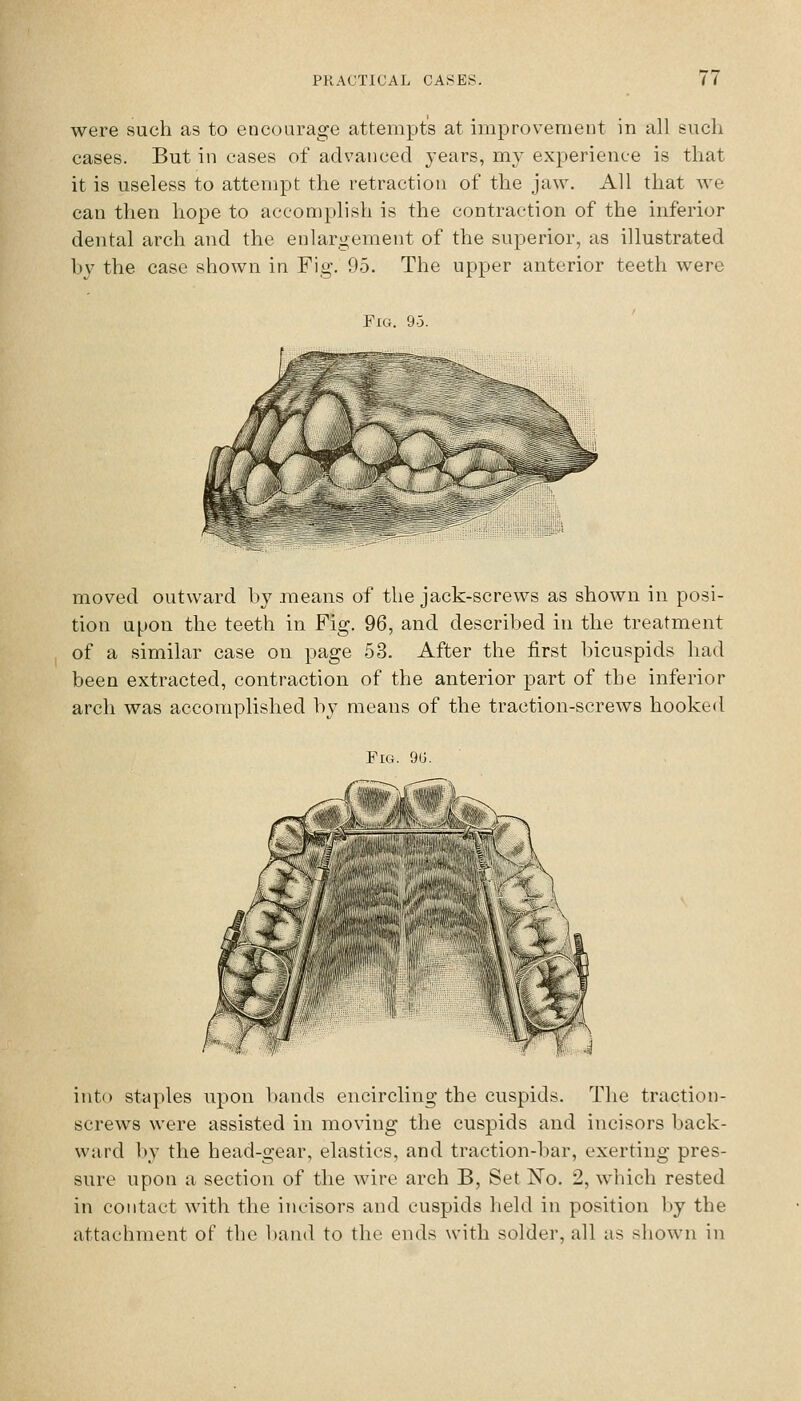 were such as to encourage attempt's at improvement in all such cases. But in cases of advanced years, my experience is that it is useless to attempt the retraction of the jaw. All that we can then hope to accomplish is the contraction of the inferior dental arch and the enlargement of the superior, as illustrated by the case shown in Fig. 95. The upper anterior teeth were Fig. 9-5. moved outward by means of the jack-screws as shown in posi- tion upon the teeth in Fig. 96, and described in the treatment of a similar case on page 53. After the first bicuspids had been extracted, contraction of the anterior part of the inferior arch was accomplished by means of the traction-screws hooked Fig. 9(J. into staples upon l)ands encircling the cuspids. The traction- screws were assisted in moving the cuspids and incisors back- ward by the head-gear, elastics, and traction-bar, exerting pres- sure upon a section of the wire arch B, Set No. 2, which rested in contact with the incisors and cuspids held in position by the attachment of the band to the ends with solder, all as shown in