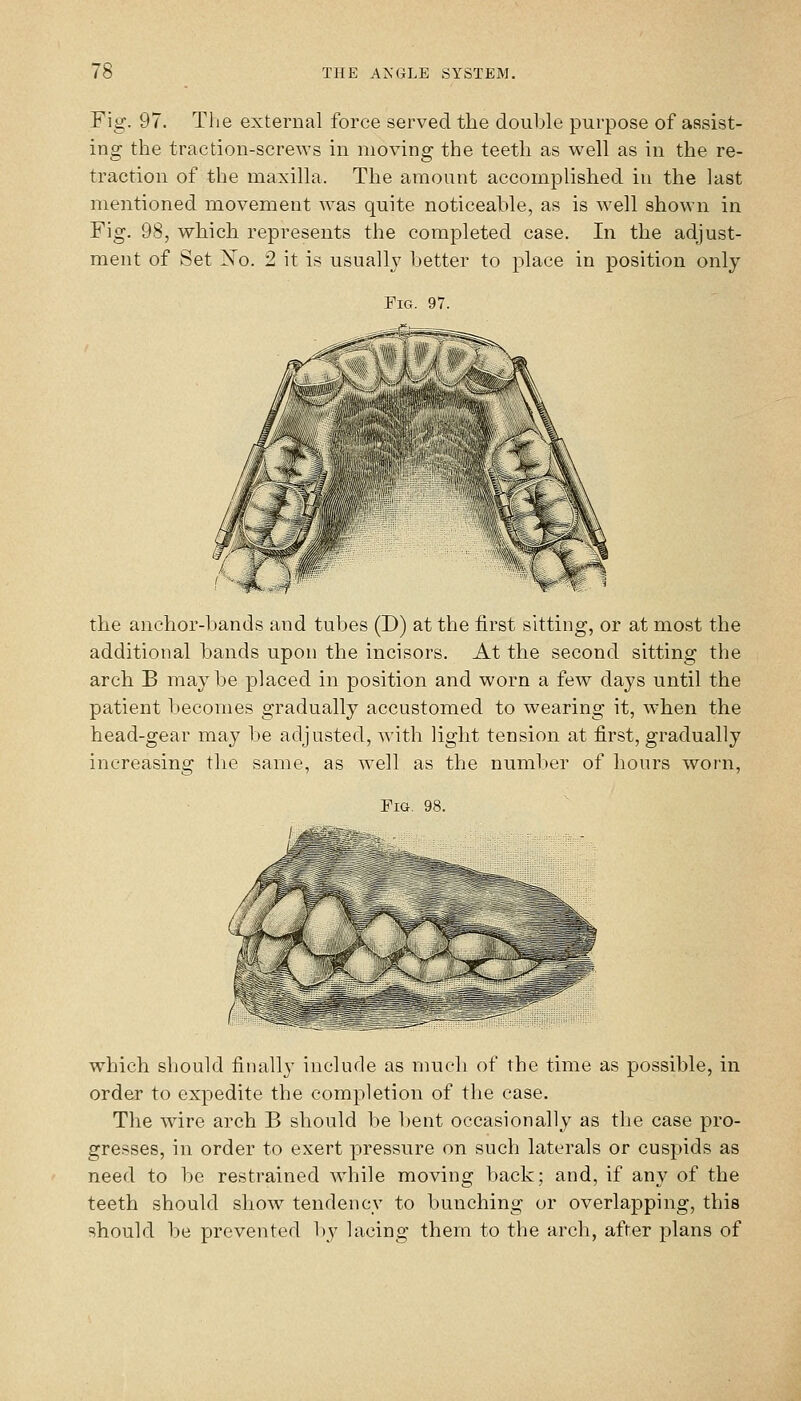 Fig. 97. The external force served the double purpose of assist- ing the traction-screws in moving the teeth as well as in the re- traction of the maxilla. The amount accomplished in the last mentioned movement was quite noticeable, as is well shown in Fig. 98, which represents the completed case. In the adjust- ment of Set ^nTo. 2 it is usually better to place in position only the anchor-bands and tubes (D) at the first sitting, or at most the additional bands upon the incisors. At the second sitting the arch B maybe placed in position and worn a few days until the patient becomes gradually accustomed to wearing it, when the head-gear may be adjusted, wath light tension at first, gradually increasing tlie same, as well as the number of hours worn, Fig, 98. /-I^^^^^fes which should finally include as much of the time as possible, in order to expedite the completion of the case. The wire arch B should be bent occasionally as the case pro- gresses, in order to exert pressure on such laterals or cuspids as need to be restrained while moving back; and, if any of the teeth should show tendency to bunching or overlapping, this should be prevented l)y lacing them to the arch, after plans of