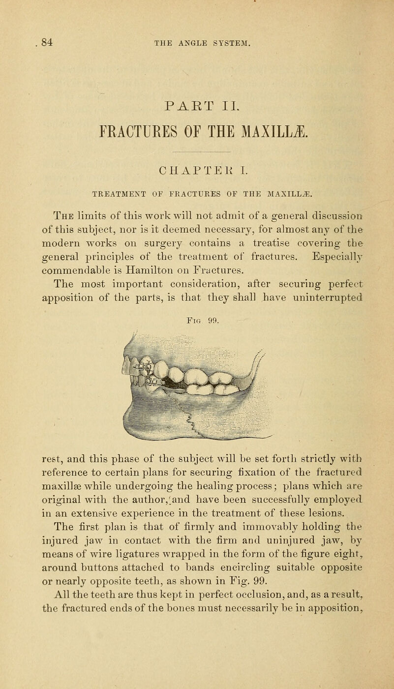 PAET IL FRACTURES OF THE MMILIM. CHAPTEK I. TREATMENT OF FRACTURES OF THE MAXILLA. The limits of this work will not admit of a general discussion of this subject, nor is it deemed necessary, for almost any of the modern works on surgery contains a treatise covering the general principles of the treatment of fractures. Especially commendable is Hamilton on Fractures. The most important consideration, after securing perfect apposition of the parts, is that they shall have uninterrupted Fig 99. rest, and this phase of the subject will be set forth strictly with reference to certain plans for securing fixation of the fractured maxillae while undergoing the healing process; plans which are original with the author,'and have been successfully employed in an extensive experience in the treatment of these lesions. The first plan is that of firmly and immovably holding the injured jaw in contact with the firm and uninjured jaw, by means of wire ligatures wrapped in the form of the figure eight,. around buttons attached to bands encircling suitable opposite or nearly opposite teeth, as shown in Fig. 99. All the teeth are thus kept in perfect occlusion, and, as a result, the fractured ends of the bones must necessarily be in apposition^