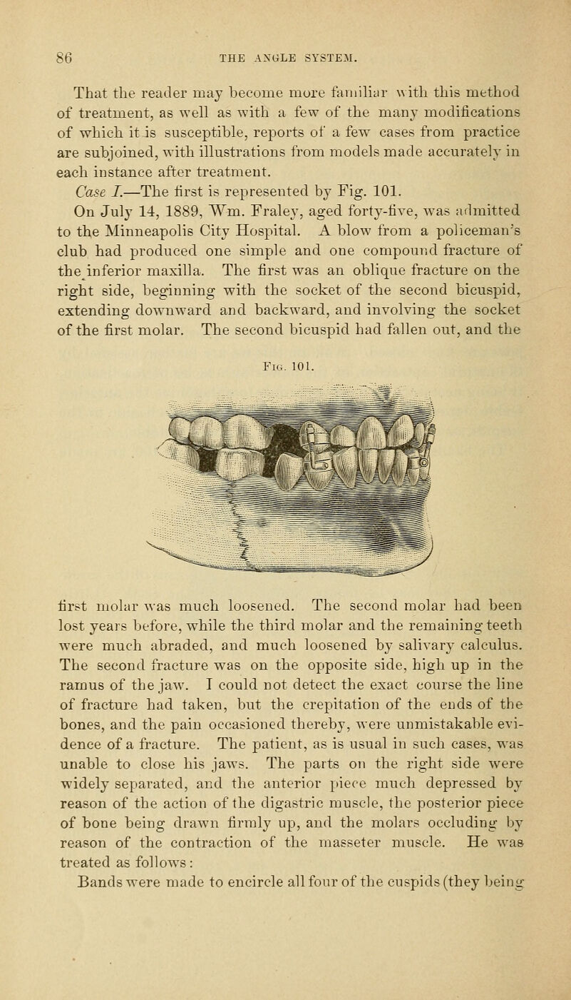 That the reader may become more faniilicir with this method of treatment, as well as with a few of the many modifications of which it is susceptible, reports of a few cases from practice are subjoined, with illustrations from models made accurately in each instance after treatment. Case I.—The first is represented by Fig. 101. On July 14, 1889, Wm. Fraley, aged forty-five, was admitted to the Minneapolis City Hospital. A blow from a policeman's club had produced one simple and one compound fracture of the inferior maxilla. The first was an oblique fracture on the right side, beginning with the socket of the second bicuspid, extending downward and backward, and involving the socket of the first molar. The second bicuspid had fallen out, and the Fig. 101. first molar was much loosened. The second molar had been lost years before, while the third molar and the remaining teeth were much abraded, and much loosened by salivary calculus. The second fracture was on the opposite side, high up in the ramus of the jaw\ I could not detect the exact course the line of fracture had taken, but the crepitation of the ends of the bones, and the pain occasioned thereby, were unmistakable evi- dence of a fracture. The patient, as is usual in such cases, was unable to close his jaws. The parts on the right side were widely separated, and the anterior piece much depressed by reason of the action of the digastric muscle, the posterior piece of bone being drawui firmly up, and the molars occluding by reason of the contraction of the masseter muscle. He was treated as follow^s: Bands were made to encircle all four of the cuspids (they being