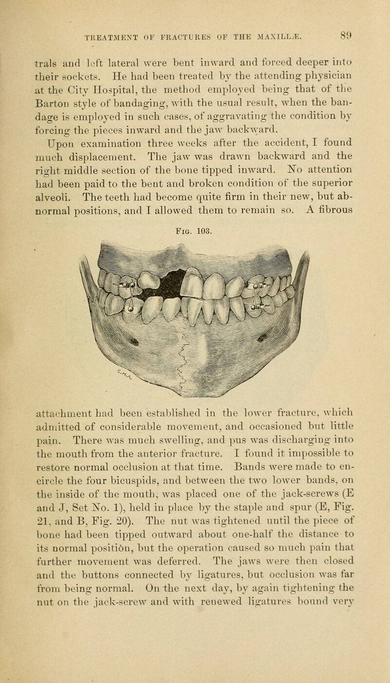 trals and left lateral were bent inward and forced deeper into their sockets. He had been treated by the attending physician at the City Hospital, the method employed being that of the Barton style of bandaging, with the usual result, when the ban- dage is employed in such cases, of aggravating the condition by forcing the pieces inward and the jaw backward. Upon examination three weeks after the accident, I found much displacement. The jaw was drawn backward and the right middle section of the bone tipped inward, l^o attention had been paid to the bent and broken condition of the superior alveoli. The teeth had become quite firm in their new, but ab- normal positions, and I allowed them to remain so. A fibrous Fig. 103. attachment had been established in the lower fracture, which admitted of considerable movement, and occasioned but little pain. There was much swelling, and pus was discharging into the mouth from the anterior fracture. I found it impossible to restore normal occlusion at that time. Bands were made to en- circle the four bicuspids, and between the two lower bands, on the inside of the mouth, was placed one of the jack-screws (E and J, Set 'No. 1), held in place by the staple and spur (E, Fig. 21, and B, Fig. 20). The nut was tightened until the piece of bone had been tipped outward about one-half the distance to its normal position, but the operation caused so much pain that further movement was deferred. The jaws were then closed and the buttons connected by ligatures, but occlusion was far from being normal. On the next day, by again tightening the nut on the jack-screw and with renewed ligatures bound very