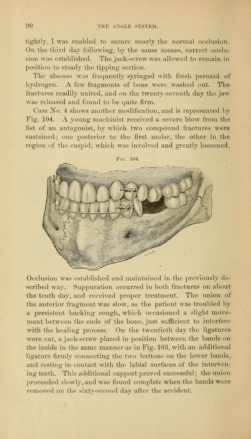 tightly, I was enabled to secure nearly the normal occlusion. On the third day following, by the same means, correct occlu- sion was established. The jack-screw was allowed to remain in position to steady the tipping section. The abscess was frequently syringed with fresh peroxid of hydrogen. A few fragments of bone were washed out. The fractures readily united, and on the twenty-seventh day the jaw was released and found to be quite firm. Case ISTo. 4 shows another modification, and is represented by Fig. 104. A young machinist received a severe blow from the fist of an antagonist, by which two compound fractures were sustained; one posterior to the first molar, the other in the region of the cuspid, which was involved and greatly loosened. Tig. 104. Occlusion was established and maintained in the previously de- scribed way. Suppuration occurred in both fractures on about the tenth day, and received proper treatment. The union of the anterior fragment was slow, as the patient was troubled by a persistent hacking cough, which occasioned a slight move- ment between the ends of the bone, just sufficient to interfere with the healing process. On the twentieth day the ligatures were cut, a jack-screw placed in position between the bands on the inside in the same manner as in Fig. 103, with an additional ligature firmly connecting the two buttons on the lower bands, and resting in contact with the labial surfaces of the interven- ing teeth. This additional support proved successful; the union proceeded slowly, and was found complete when the bands were removed on the sixty-second day after the accident.