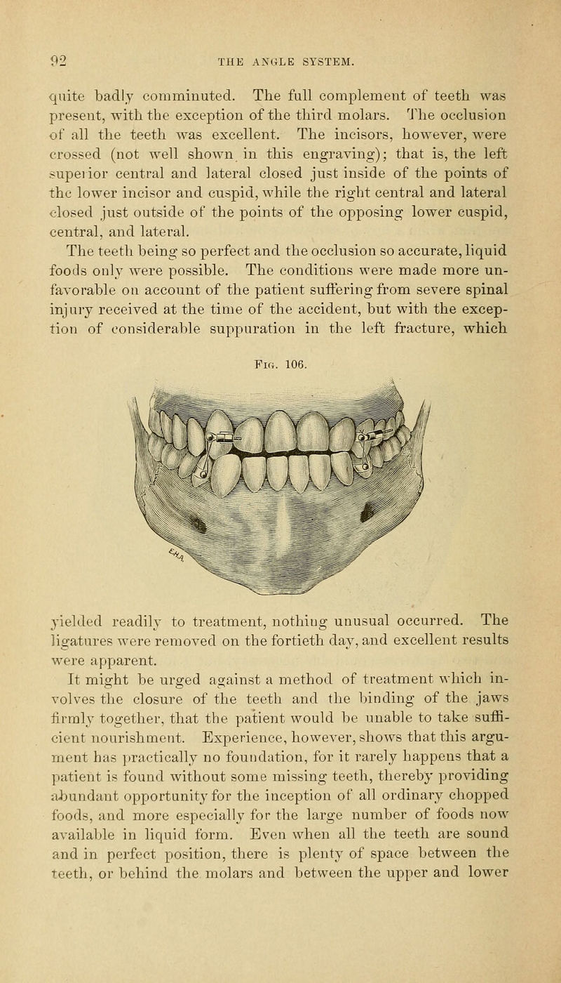 quite badly comminuted. The full complement of teeth was present, with the exception of the third molars. 'Jlie occlusion of all the teeth was excellent. The incisors, however, were crossed (not well shown in this engraving); that is, the left superior central and lateral closed just inside of the points of the lower incisor and cuspid, while the right central and lateral closed just outside of the points of the opposing lower cuspid, central, and lateral. The teeth being so perfect and the occlusion so accurate, liquid foods only were possible. The conditions were made more un- favorable on account of the patient sufteringfrom severe spinal injury received at the time of the accident, but with the excep- tion of considerable suppuration in the left fracture, which Fig. 106. yielded readily to treatment, nothing unusual occurred. The ligatures were removed on the fortieth day, and excellent results were apparent. It might be ur^ed against a method of treatment which in- volves the closure of the teeth and the binding of the jaws iirraly together, that the patient would be unable to take suffi- cient nourishment. Experience, however, shows that this argu- ment has practically no foundation, for it rarely happens that a patient is found without some missing teeth, thereby providing al)undant opportunity for the inception of all ordinary chopped foods, and more especially for the large number of foods now available in liquid form. Even when all the teeth are sound and in perfect position, there is plenty of space between the teeth, or behind the molars and between the upper and lower