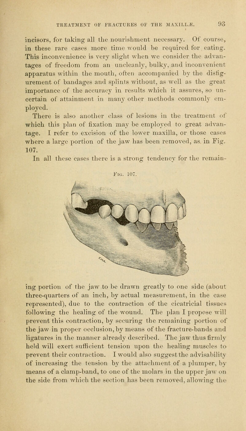 incisors, for taking all the nourishment necessary. Of course, in these rare cases more time would be required for eating. This inconvenience is very slight when we consider the advan- tages of freedom from an uncleanly, bulky, and inconvenient apparatus within the mouth, often accompanied by the distig- urement of bandages and splints without, as well as the great importance of the accuracy in results which it assures, so un- certain of attainment in many other methods commonly em- ployed. There is also another class of lesions in the treatment of which this plan of fixation may be employed to great advan- tage. I refer to excision of the lower maxilla, or those cases where a large portion of the jaw has been removed, as. in Fig. 107. In all these cases there is a strong tendency for the remain- Fiu. 107. ing portion of the jaw to be drawn greatly to one side (about three-quarters of an inch, by actual measurement, in the case represented), due to the contraction of the cicatricial tissues following the healing of the wound. The plan I propose wmII prevent this contraction, by securing the remaining portion of the jaw in proper occlusion, by means of the fracture-bands and ligatures in the manner already described. The jaw thus firmly held will exert sutiicient tension upon the healing muscles to prevent their contraction. I would also suggest the advisability of increasing the tension by the attachment of a plumper, by means of a clamp-band, to one of the molars in the upper jaw on the side from which the section has been removed, allowino- the