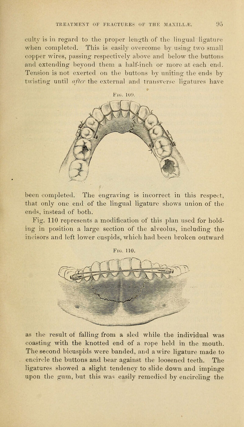 culty is in regard to the proper leiii^'th of the lingual ligature when completed. This is easily overcome by using two small copper wires, passing respectively above and below the buttons and extending beyond them a half-inch or more at each end. Tension is not exerted on the buttons by uniting the ends by twisting until after the external and transverse ligatures have Fi(i. 109. been completed. The engraving is incorrect in this respect, that only one end of the lingual ligature shows union of the ends, instead of both. Fig. 110 represents a modification of this plan used for hold- ing in position a large section of the alveolus, including the incisors and left lower cuspids, which had been broken outward Fig. 110. as the result of falling from a sled while the individual was coasting with the knotted end of a rope held in the mouth. The second bicuspids were banded, and a wire ligature made to encircle the buttons and bear against the loosened teeth. The ligatures showed a slight tendency to slide down and impinge upon the gum, but this was easily remedied by encircling the