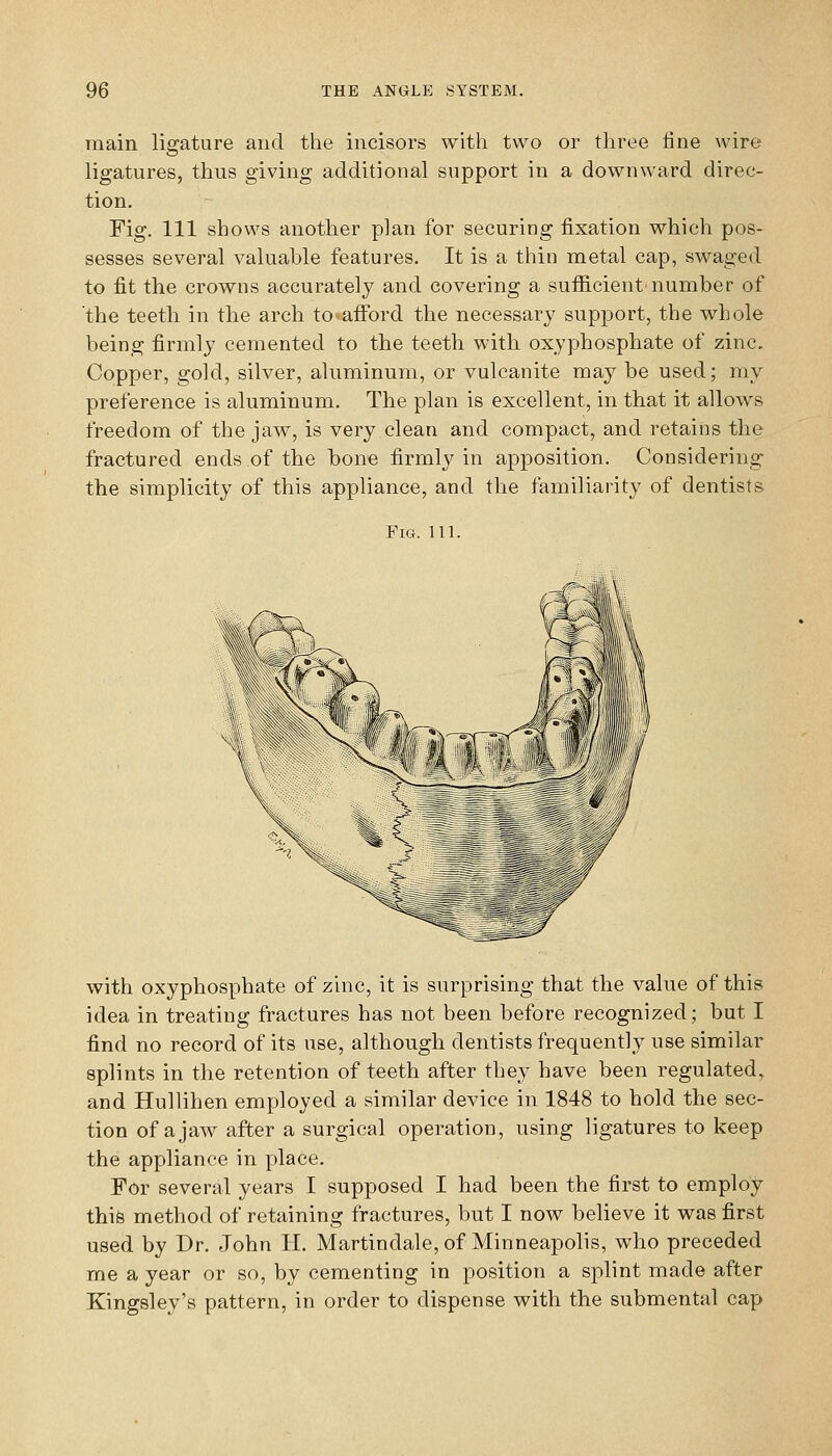 main ligature and the incisors with two or three fine wire ligatures, thus giving additional support in a downward direc- tion. Fig. Ill shows another plan for securing fixation which pos- sesses several valuable features. It is a thin metal cap, swaged to fit the crowns accurately and covering a sufficient number of 'the teeth in the arch to aiford the necessary support, the whole being firmly cemented to the teeth with oxyphosphate of zinc. Copper, gold, silver, aluminum, or vulcanite may be used; my preference is aluminum. The plan is excellent, in that it allows freedom of the jaw, is very clean and compact, and retains the fractured ends of the bone firmly in apposition. Considering the simplicity of this appliance, and the familiarity of dentists Fig. 111. with oxyphosphate of zinc, it is surprising that the value of this idea in treating fractures has not been before recognized; but I find no record of its use, although dentists frequently use similar splints in the retention of teeth after they have been regulated, and Hullihen employed a similar device in 1848 to hold the sec- tion of a jaw after a surgical operation, using ligatures to keep the appliance in place. For several years I supposed I had been the first to employ this method of retaining fractures, but I now believe it was first used by Dr. John H. Martindale, of Minneapohs, who preceded me a year or so, by cementing in position a splint made after Kingsley's pattern, in order to dispense with the submental cap