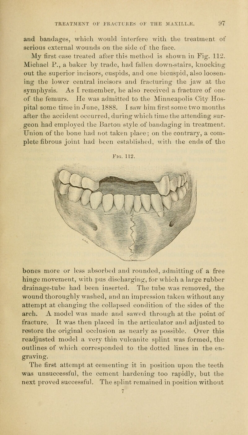 and bandages, which would interfere with the treatment of serious external wounds on the side of the face. My first case treated after this method is shown in Fig. 112. Michael P., a baker by trade, had fallen down-stairs, knocking out the superior incisors, cuspids, and one bicuspid, also loosen- ing the lower central incisors and fracturing the jaw at the symphysis. As I remember, he also received a fracture of one of the femurs. He was admitted to the Minneapolis City Hos- pital some time in June, 1888. I saw him first som_e two months after the accident occurred, during which time the attending sur- geon had employed the Barton style of bandaging in treatment. Union of the bone had not taken place; on the contrary, a com- plete fibrous joint had been established, Avith the ends of the Fig. 112. bones more or less absorbed and rounded, admitting of a free hinge movement, with pus discharging, for which a large rubber drainage-tube had been inserted. The tube was removed, the wound thoroughly washed, and an impression taken w^ithout any attempt at changing the collapsed condition of the sides of the arch. A model was made and sawed through at the point of fracture. It was then placed in the articulator and adjusted to restore the original occlusion as nearly as possible. Over this readjusted model a very thin vulcanite splint was formed, the outlines of which corresponded to the dotted lines in the en- graving. The first attempt at cementing it in position upon the teeth was unsuccessful, the cement hardening too rapidly, but the next proved successful. The splint remained in position without 7