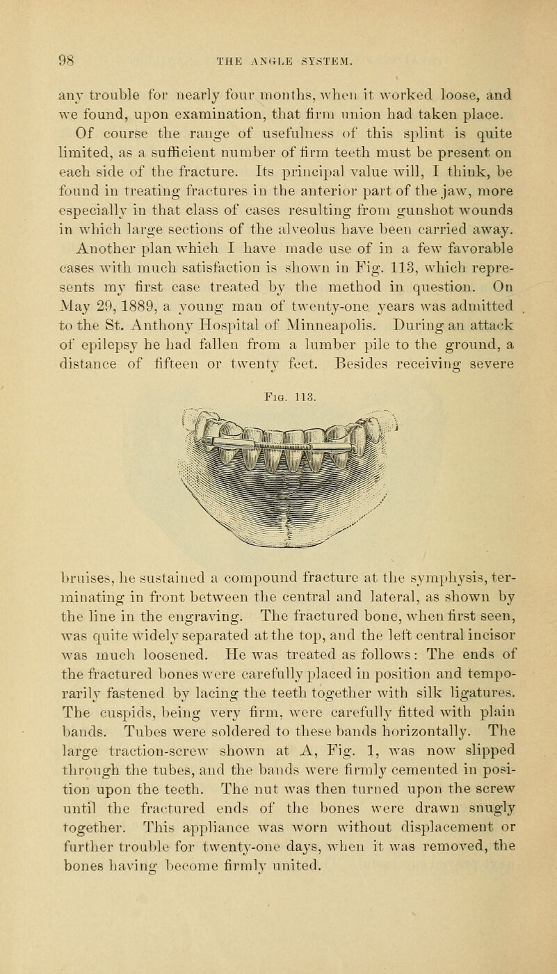 any trouble for nearly four months,-when it worked loose, and we found, upon examination, that firm union had taken place. Of course the range of usefulness of this splint is quite limited, as a sufficient number of firm teeth must be present on each side of the fracture. Its principal value will, I think, be found in treating fractures in the anterior part of the jaw, more especially in that class of cases resulting from gunshot wounds in which large sections of the alveolus have been carried away. Another plan which I have made use of in a few favorable cases with much satisfaction is shown in Fig. 113, which repre- sents my first case treated by the method in question. On May 29, 1889, a young man of twenty-one years was admitted to the St. Anthony Hospital of Minneapolis. During an attack of epilepsy he had fallen from a lumber pile to the ground, a distance of fifteen or twenty feet. Besides receiving severe Fig. 113. \ i bruises, lie sustained a compound fracture at the symphysis, ter- minating in front between the central and latera,l, as shown by the line in the engraving. The fractured bone, when first seen, was quite widely separated at the top, and the left central incisor was much loosened. He was treated as follows: The ends of the fractured bones were carefully placed in position and tempo- rarily fastened by lacing the teeth together with silk ligatures. The cuspids, being very firm, were carefully fitted with plain bands. Tubes were soldered to these bands horizontally. Tlie large traction-screw shown at A, Fig. 1, was now slipped through the tubes, and the bands were firmly cemented in posi- tion upon the teeth. The nut was then turned upon the screw until the fractured ends of the bones were drawn snugly together. I'his appliance was worn without displacement or further troul)le for twenty-one days, when it was removed, the bones haN-inii; l)Ccome firmlv united.