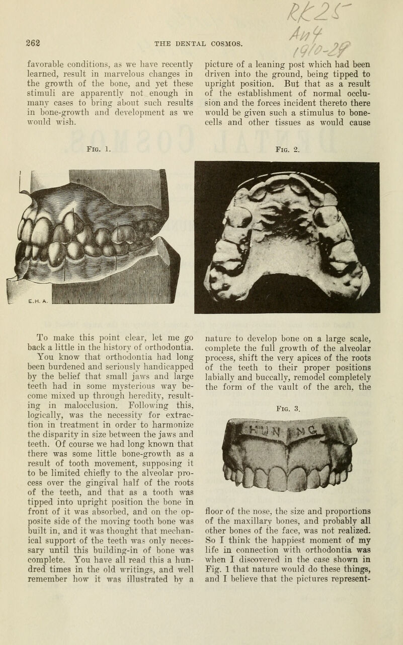 favorable conditions, as we have recently learned, result in marvelous changes in the growth of the bone, and yet these stimuli are apparently not enough in many cases to bring about such results in bone-growth and development as we would wish. picture of a leaning post which had been driven into the ground, being tipped to upright position. But that as a result of the establishment of normal occlu- sion and the forces incident thereto there would be given such a stimulus to bone- cells and other tissues as would cause Fig. 1. Fig. 2. To make this point clear, let me go back a little in the history of orthodontia. You know that orthodontia had long been burdened and seriously handicapped by the belief that small jaws and large teeth had in some mysterious way be- come mixed up through heredity, result- ing in malocclusion. Following this, logically, was the necessity for extrac- tion in treatment in order to harmonize the disparity in size between the jaws and teeth. Of course we had long known that there was some little bone-growth as a result of tooth movement, supposing it to be limited chiefly to the alveolar pro- cess over the gingival half of the roots of the teeth, and that as a tooth was tipped into upright position the bone in front of it was absorl)ed, and on the op- posite side of the moving tooth bone was built in, and it was thought that mechan- ical support of the teeth was only neces- sary until this building-in of bone was complete. You have all read this a hun- dred times in the old writings, and well remember how it was illustrated bv a nature to develop bone on a large scale, complete the full growth of the alveolar process, shift the very apices of the roots of the teeth to their proper positions labially and buccally, remodel completely the form of the vault of the arch, the Fig. 3. floor of the nose, the size and proportions of the maxillary bones, and probably all other bones of the face, was not realized. So I think the happiest moment of my life in connection with orthodontia was when I discovered in the case shown in Fig. 1 that nature would do these things, and I Ijelieve that the pictures represent-