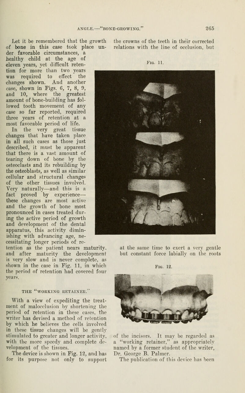 Let it be remembered that the growth of bone in this case took place un- der favorable circumstances, a healthy child at the age of eleven years, yet difficult reten- tion for more than two years was required to effect the changes shown. And another case, shown in Figs. 6, 7, 8, 9, and 10, where the greatest amount of bone-building has fol- lowed tooth, movement of any case so far reported, required three years of retention at a most favorable period of life. In the very great tissue changes that have taken place in all such cases as those just described, it must be apparent that there is a vast amount of tearing down of bone by the osteoclasts and its rebuilding by the osteoblasts, as well as similar cellular and structural changes of the other tissues involved. Very naturally—and this is a fact proved by experience— these changes are most active and the growth of bone most pronounced in cases treated dur- ing the active period of growth and development of the dental apparatus, this activity dimin- ishing with advancing age, ne- cessitating longer periods of re- tention as the patient nears maturity, and after maturity the development is very slow and is never complete, as shown in the case in Fig. 11, in which the period of retention had covered four years. THE working retainer. With a view of expediting the treat- ment of malocclusion by shortening the period of retention in these cases, the writer has devised a method of retention by which he believes the cells involved in these tissue changes will be gently stimulated to greater and longer activity, with the more speedy and complete de- velopment of the tissues. The device is shown in Fig. 12, and has for its purpose not only to support the crowns of the teeth in their corrected relations with the line of occlusion, but Fig. 11. at the same time to exert a very gentle but constant force labially on the roots Fig. 12. of the incisors. It may be regarded as a 'working retainer. as appropriately named by a former student of the writer, Dr. George B. Palmer. The publication of tliis device has been