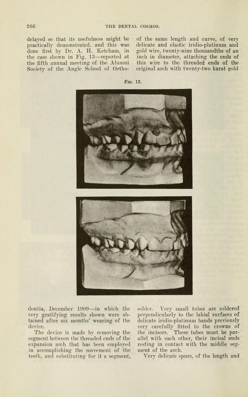 delayed so that its usefulness might be practically demonstrated, and this was done first by Dr. A. H. Ketcham, in the case shown in Fig. 13—reported at the fifth annual meeting of the Alumni Society of the Angle School of Ortho- of the same length and curve, of very delicate and elastic iridio-platinum and gold wire, twenty-nine thousandths of an inch in diameter, attaching the ends of this wire to the threaded ends of the original arch with twenty-two karat gold Fig. 13. dontia, December 1909—in which the very gratifying results shown were ob- tained after six months' wearing of the device. The device is made by removing the segment between the threaded ends of the expansion arch that has been employed in accomplishing the movement of the teeth, and substituting for it a segment. soklei'. Very small tubes are soldered perpendicularly to the labial surfaces of delicate iridio-platinum bands previously very carefully fitted to the crowns of the incisors. These tubes must be par- allel with each other, their incisal ends resting in contact with the middle seg- ment of the arch. A^ery delicate spurs, of the length and