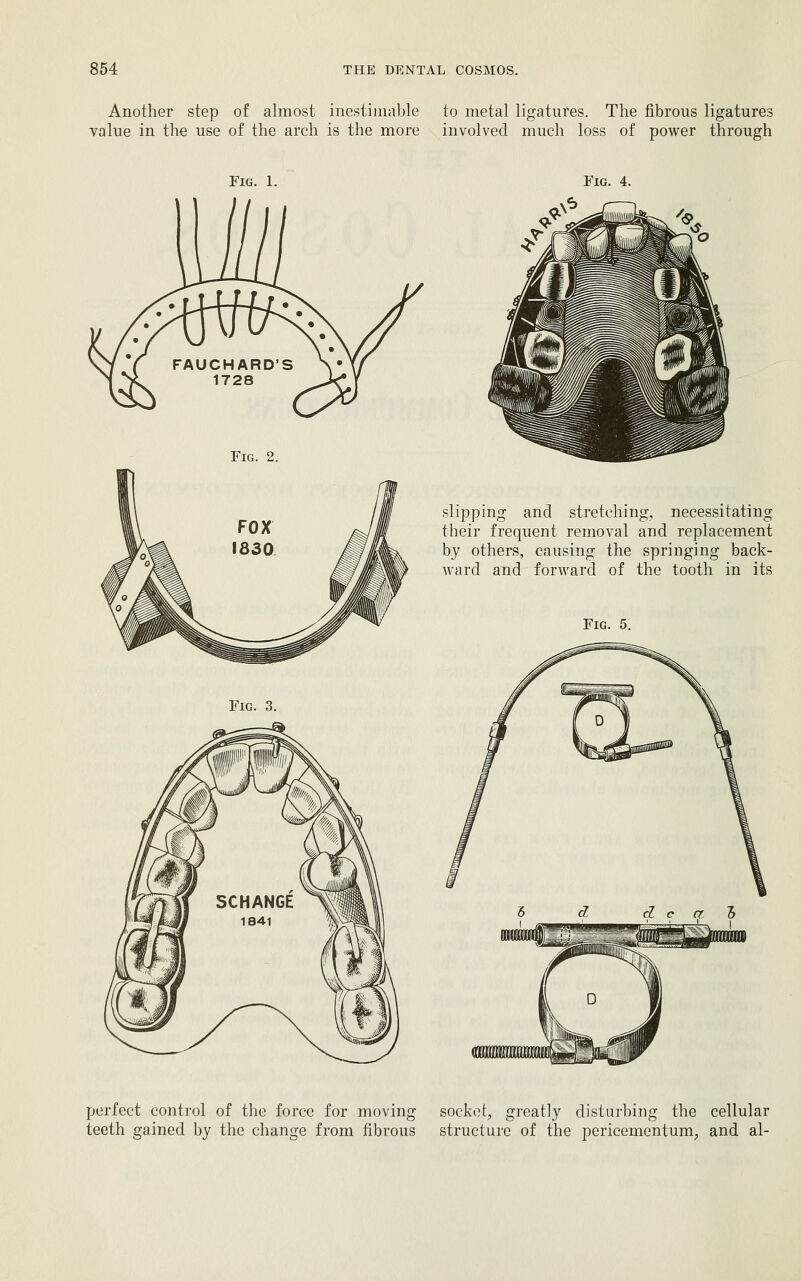 Another step of almost inestimable to metal ligatures. The fibrous ligatures value in the use of the arch is the more involved much loss of power through Fig. 1. Fig. 4. Fig. 2. Fig. 3. .slipping and stretching, necessitating their frequent removal and replacement by others, causing the springing back- ward and forward of the tooth in its Fig. 5. perfect control of the force for moving socket, greatly disturbing the cellular teeth gained by the change from fibrous structure of the pericementum, and al-