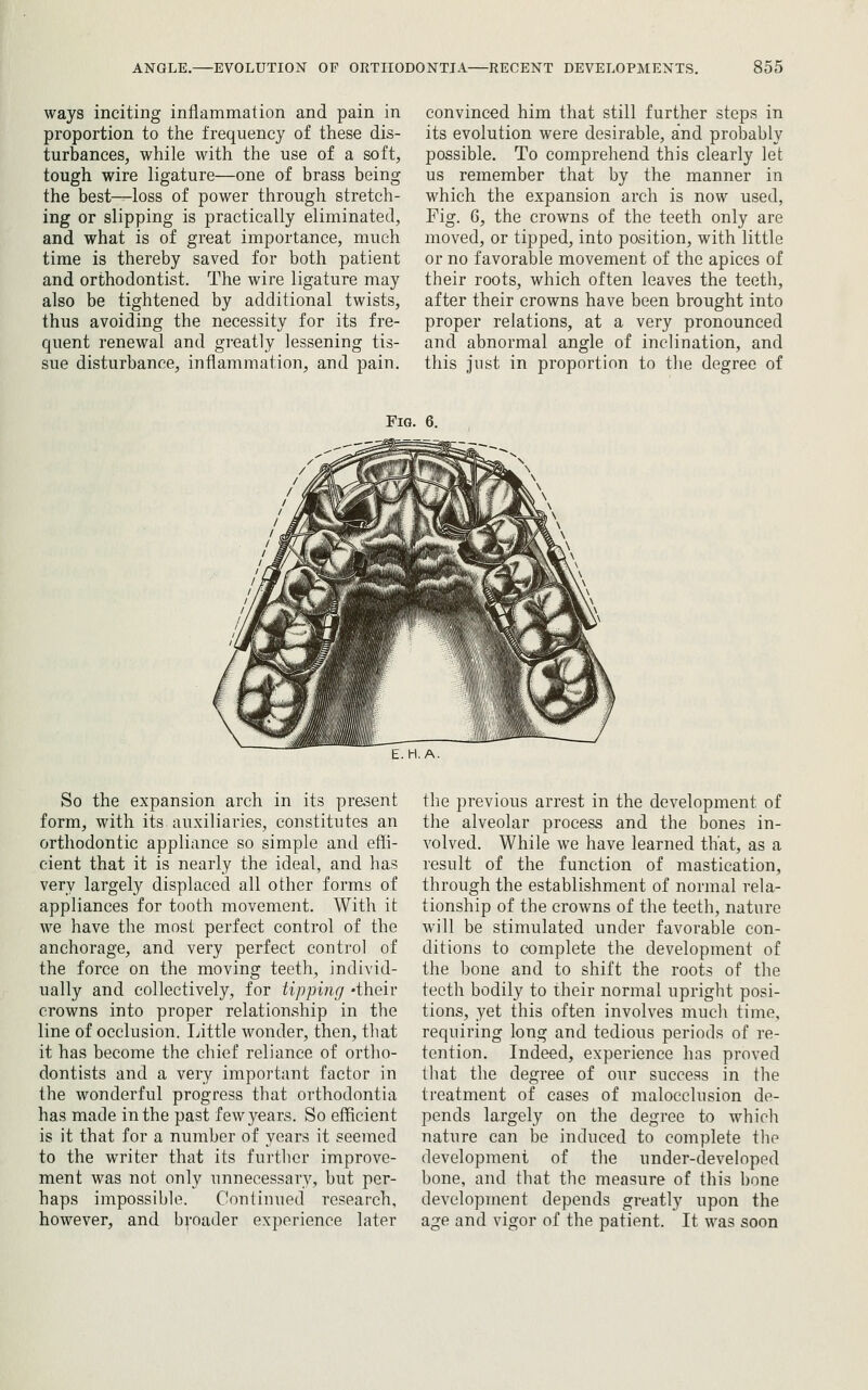 ways inciting inflammation and pain in proportion to the frequency of these dis- turbances, while with the use of a soft, tough wire ligature—one of brass being the best—loss of power through stretch- ing or slipping is practically eliminated, and what is of great importance, much time is thereby saved for both patient and orthodontist. The wire ligature may also be tightened by additional twists, thus avoiding the necessity for its fre- quent renewal and greatly lessening tis- sue disturbance, inflammation, and pain. convinced him that still further steps in its evolution were desirable, and probably possible. To comprehend this clearly let us remember that by the manner in which the expansion arch is now used, Fig. 6, the crowns of the teeth only are moved, or tipped, into pasition, with little or no favorable movement of the apices of their roots, which often leaves the teeth, after their crowns have been brought into proper relations, at a very pronounced and abnormal angle of inclination, and this Just in proportion to the degree of Fig. 6. E. H. A. So the expansion arch in its present form, with its auxiliaries, constitutes an orthodontic appliance so simple and effi- cient that it is nearly the ideal, and has very largely displaced all other forms of appliances for tooth movement. With it we have the most perfect control of the anchorage, and very perfect control of the force on the moving teeth, individ- ually and collectively, for tipping -their crowns into proper relationship in the line of occlusion. Little wonder, then, that it has become the chief reliance of ortho- dontists and a very important factor in the wonderful progress that orthodontia has made in the past few years. So eiflcient is it that for a number of years it seemed to the writer that its further improve- ment was not only unnecessary, but per- haps impossible. Continued research, however, and broader experience later the previous arrest in the development of the alveolar process and the bones in- volved. While we have learned that, as a result of the function of mastication, through the establishment of normal rela- tionship of the crowns of the teeth, nature will be stimulated under favorable con- ditions to complete the development of the bone and to shift the roots of the teeth bodily to their normal upright posi- tions, yet this often involves much time, requiring long and tedious periods of re- tention. Indeed, experience has proved that the degree of our success in the treatment of cases of malocclusion de- pends largely on the degree to which nature can be induced to complete the development of the under-developed bone, and that the measure of this bone development depends greatly upon the age and vigor of the patient. It was soon