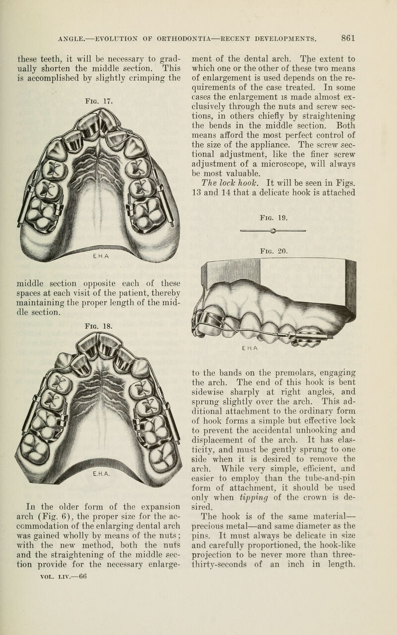 these teeth, it will be necessary to grad- ually shorten the middle section. This is accomplished by slightly crimping the middle section opposite each of these spaces at each visit of the patient, thereby maintaining the proper length of the mid- dle section. Fig In the older form of the expansion arch (Fig. 6), the proper size for the ac- commodation of the enlarging dental arch was gained wholly by means of the nuts; vrith the new method, both the nuts and the straightening of the middle sec- tion provide for the necessary enlarge- VOL. LIV.—66 ment of the dental arch. The extent to which one or the other of these two means of enlargement is used depends on the re- quirements of the case treated. In some eases the enlargement is made almost ex- clusively through the nuts and screw sec- tions, in others chiefly by straightening the bends in the middle section. Both means afford the most perfect control of the size of the appliance. The screw sec- tional adjustment, like the finer screw adjustment of a microscope, will always be most valuable. The lock hook. It will be seen in Figs. 13 and 14 that a delicate hook is attached Fig. U Fig. 20. to the bands on the premolars, engaging the arch. The end of this hook is bent side wise sharply at right angles, and sprung slightly over the arch. This ad- ditional attachment to the ordinary form of hook forms a simple but effective lock to prevent the accidental unhooking and displacement of the arch. It has elas- ticity, and must be gently sprung to one side when it is desired to remove the arch. While very simple, efficient, and easier to employ than the tube-and-pin form of attachment, it should be used only when tipping of the crown is de- sired. The hook is of the same material— precious metal—and same diameter as the pins. It must always be delicate in size and carefully proportioned, the hook-like projection to be never more than three- thirtv-seconds of an inch in length.