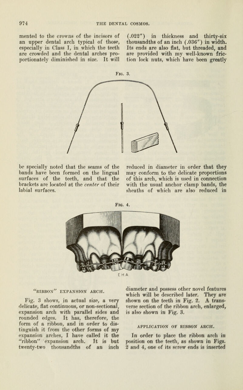 mented to the crowns of the incisors of an upp€r dental arch typical of those, especially in Class I, in which the teeth are crowded and the dental arches pro- portionately diminished in size. It will (.022) in thickness and thirty-six thousandths of an inch (.036) in width. Its ends are also flat, but threaded, and are provided with my well-known fric- tion lock nuts, which have been greatly Fig. 3. be specially noted that the seams of the bands have been formed on the lingual surfaces of the teeth, and that the brackets are located at the center of their labial surfaces. reduced in diameter in order that they may conform to the delicate proportions of this arch, which is used in connection with the usual anchor clamp bands, the sheaths of which are also reduced in Fig. 4. RIBBON EXPANSION ARCH. Fig. 3 shows, in actual size, a very delicate, flat continuous, or non-sectional, expansion arch with parallel sides and rounded edges. It has, therefore, the form of a ribbon, and in order to dis- tinguish it from the other forms of my expansion arches, I have called it the ribbon expansion arch. It is but twenty-two thousandths of an inch diameter and possess other novel features which will be described later. They are shown on the teeth in Fig. 2. A trans- verse section of the ribbon arch, enlarged, is also shown in Fig. 3. APPLICATION OF RIBBON ARCH. In order to place the ribbon arch in position on the teeth, as shown in Figs. 2 and 4, one of its screw ends is inserted