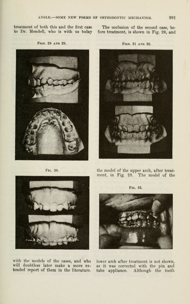 treatment of both this and the first case The occlusion of the second case, be- to Dr. Mendell, who is with us today fore treatment, is shown in Fig. 28, and Figs. 28 and 29. Figs. 31 a\d 32. Fig. 30. the model of the upper arch, after treat- ment, in Fig. 29. The model of the Fig. 33. with the models of the cases, and who lower arch after treatment is not shown, will doubtless later make a more ex- as it was corrected with the pin and tended report of them in the literature, tube appliance. Although the tootli