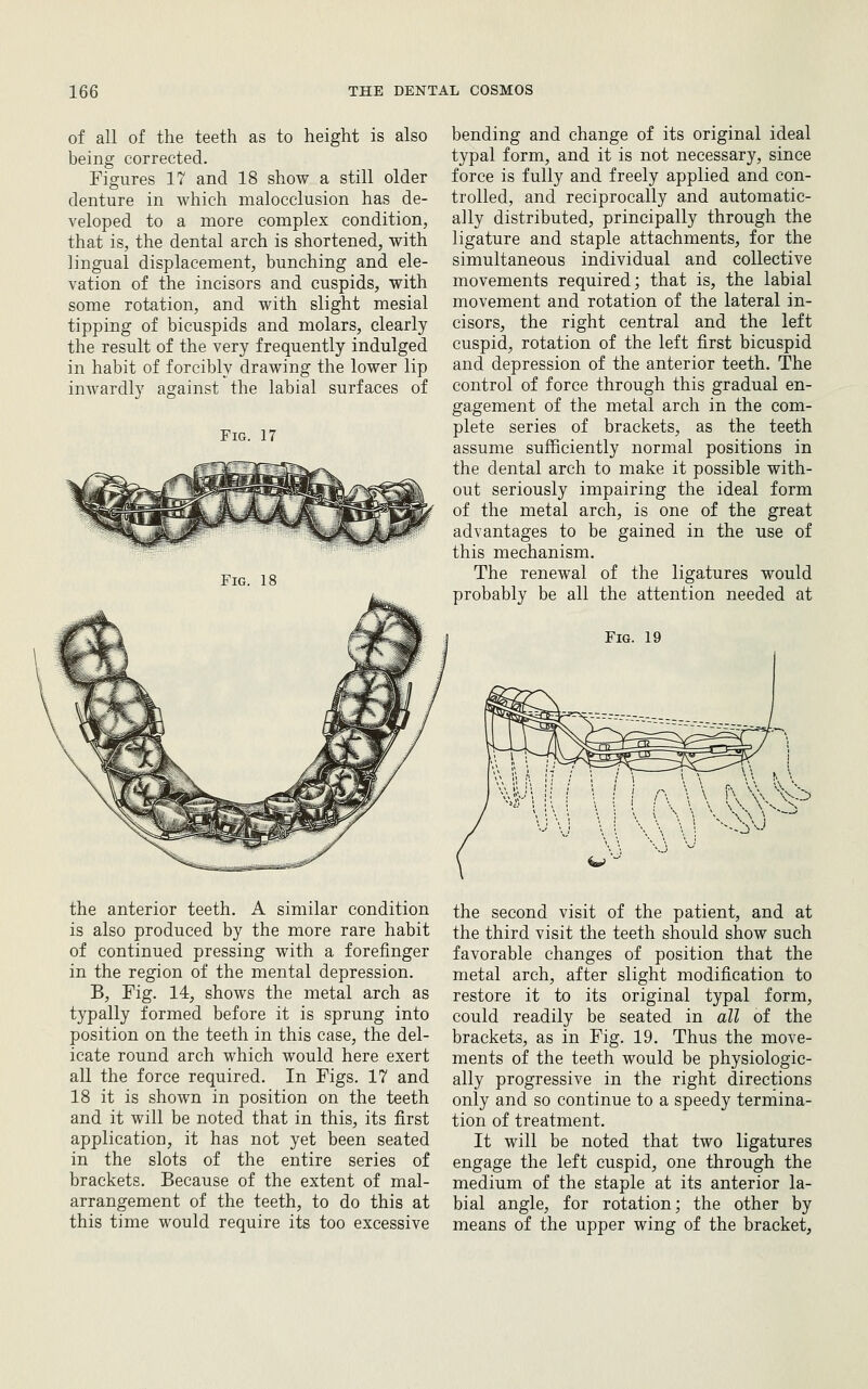 of all of the teeth as to height is also being corrected. Figures 17 and 18 show a still older denture in which malocclusion has de- veloped to a more complex condition, that is, the dental arch is shortened, with lingual displacement, bunching and ele- vation of the incisors and cuspids, with some rotation, and with slight mesial tipping of bicuspids and molars, clearly the result of the very frequently indulged in habit of forcibly drawing the lower lip inwardly against the labial surfaces of Fig. 17 Fig. 18 bending and change of its original ideal typal form, and it is not necessary, since force is fully and freely applied and con- trolled, and reciprocally and automatic- ally distributed, principally through the ligature and staple attachments, for the simultaneous individual and collective movements required; that is, the labial movement and rotation of the lateral in- cisors, the right central and the left cuspid, rotation of the left first bicuspid and depression of the anterior teeth. The control of force through this gradual en- gagement of the metal arch in the com- plete series of brackets, as the teeth assume sufficiently normal positions in the dental arch to make it possible with- out seriously impairing the ideal form of the metal arch, is one of the great advantages to be gained in the use of this mechanism. The renewal of the ligatures would probably be all the attention needed at the anterior teeth. A similar condition is also produced by the more rare habit of continued pressing with a forefinger in the region of the mental depression. B, Fig. 14, shows the metal arch as typally formed before it is sprung into position on the teeth in this case, the del- icate round arch which would here exert all the force required. In Figs. 17 and 18 it is shown in position on the teeth and it will be noted that in this, its first application, it has not yet been seated in the slots of the entire series of brackets. Because of the extent of mal- arrangement of the teeth, to do this at this time would require its too excessive the second visit of the patient, and at the third visit the teeth should show such favorable changes of position that the metal arch, after slight modification to restore it to its original typal form, could readily be seated in all of the brackets, as in Fig. 19. Thus the move- ments of the teeth would be physiologic- ally progressive in the right directions only and so continue to a speedy termina- tion of treatment. It will be noted that two ligatures engage the left cuspid, one through the medium of the staple at its anterior la- bial angle, for rotation; the other by means of the upper wing of the bracket.