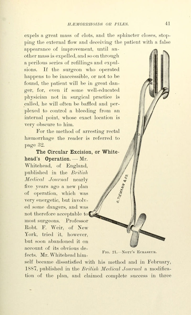 expels a great mass of clots, and the sphincter closes, stop- ping the external How and deceiA'ing the patient with a false appearance of improvement, until an- other mass is expelled, and so on through a perilous series of refiUings and expul- sions. If the surgeon who operated happens to be inaccessible, or not to be found, the patient will be in great dan- ger, for, even if some well-educated physician not in surgical practice is called, he will often be baffled and per- plexed to control a bleeding from an internal point, whose exact location is very obscure to him. For the method of arresting rectal haemorrhage the reader is referred to page 32. The Circular Excision, or White- head's Operation, — Mr. Whitehead, of England, published in the British Medical Journal nearly five years ago a new plan of operation, which was very energetic, but involv- ed some dangers, and was not tlierefore acceptable to( most surgeons. Professor Eobt. F. Weir, of New York, tried it, however, but soon abandoned it on account of its obvious de- fects. Mr. Whitehead him- self became dissatisfied with his method and in February, 1887, published in the Brifish Medical Jourmd a modifica- tion of the plan, and claimed complete success in three Fig. 21.—Nott's Ecbaseub.