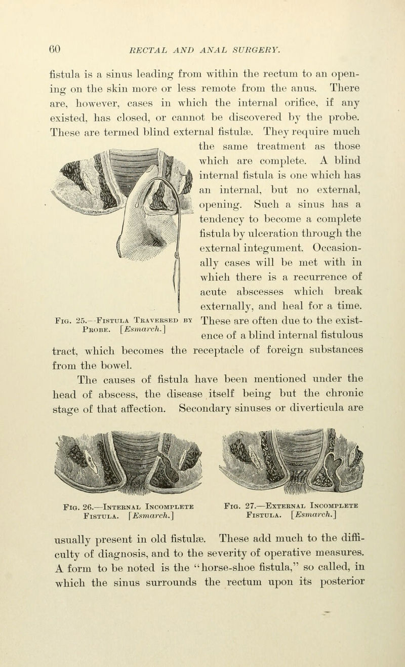 fistula is a sinus leading from within the rectum to an open- ing- on the skin more or less remote from the anus. There are, however, cases in which the internal orifice, if any existed, has closed, or cannot l)e discovered by the probe. These are termed blind external fistulas They require much the same treatment as those ™ which are complete. A blind internal fistula is one which has an internal, but no external, opening. Such a sinus has a tendency to become a complete fistula by ulceration through the external integument. Occasion- ally cases will be met with in which there is a recurrence of acute abscesses which break externally, and heal for a time. These are often due to the exist- ence of a blind internal fistulous tract, which becomes the receptacle of foreign substances from the bowel. The causes of fistula have been mentioned under the head of abscess, the disease itself being but the chronic stage of that affection. Secondary sinuses or diverticula are Fig. 25.--Fistula Tkavebsed by Peobe. \^Esmarch.^ Fig. 26.—Intebnal Incomplete Fistula. \ Esmarch.^ Fig. 27.—External Incomplete Fistula. {Esmarch.'] usually present in old fistulse. These add much to the diffi- culty of diagnosis, and to the severity of operative measures. A form to be noted is the horse-shoe fistula, so called, in which the sinus surrounds the rectum upon its posterior