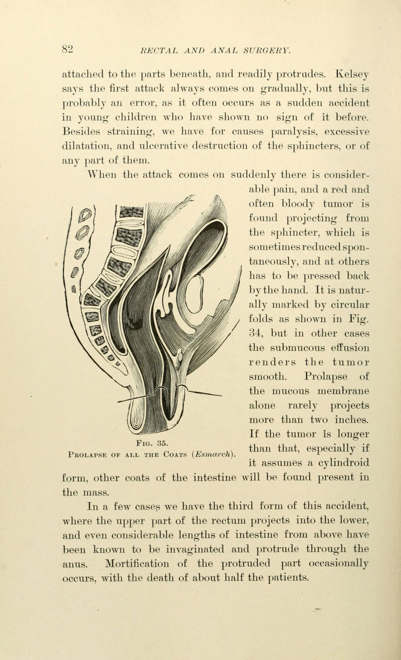 attached to the parts beneath, and readily protrudes. Kelsey says the first attack always comes on gradually, hut this is probably an error, as it often occurs as a sudden accident in young children who have shown no sign of it before. Besides straining, we have for causes paralysis, excessive dilatation, and ulcerative destruction of the sphincters, or of any part of them. When the attack comes on suddenly there is consider- able pain, and a red and often bloody tumor is found projecting from the sphincter, which is sometimes reduced spon- taneously, and at others has to be pressed back by the hand. It is natur- ally marked by circular folds as shown in Fig. 34, but in other cases the submucous effusion renders the tumor smooth. Prolapse of the mucous membrane alone rarely projects more than two inches. If the tumor is longer than that, especially if it assumes a cylindroid form, other coats of the intestine will be found present in the mass. In a few cases we have the third form of this accident, where the upper part of the rectum projects into the lower, and even considerable lengths of intestine from above have been known to be invaginated and protrude through the anus. Mortification of the protruded part occasionally occurs, with the death of about half the patients. Fig. 35. Pkolapse of all the Coats (Esmarch).