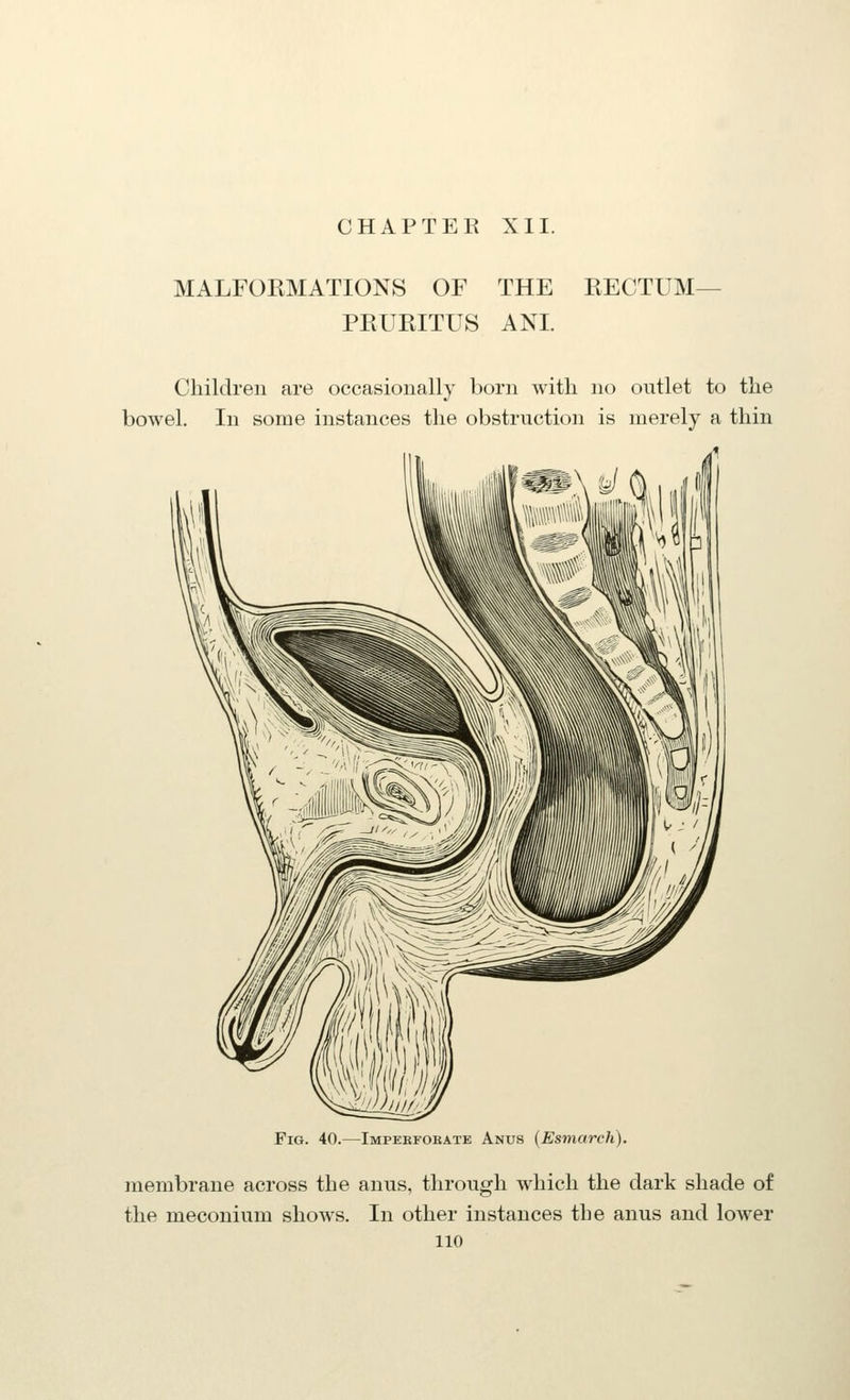 CHAPTER XII. MALFORMATIONS OF THE RECTUM- PRURITUS ANI. Children are occasionally born with no outlet to the bowel. In some instances the obstruction is merely a thin 1 Fig. 40.—Impekfoeate Anus (Esmarch). membrane across the anus, through which the dark shade of the meconium shows. In other instances the anus and lower