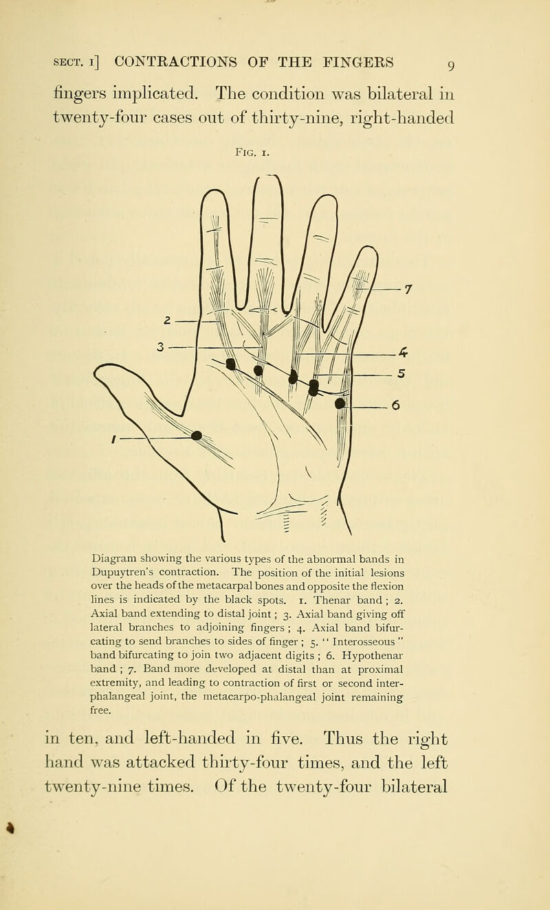 fingers imjDlicated. The condition was bilateral in twenty-four cases out of thirty-nine, right-handed Fig. I. Diagram showing the various types of the abnormal bands in Dupuytren's contraction. The position of the initial lesions over the heads of the metacarpal bones and opposite the flexion lines is indicated by the black spots, i. Thenar band ; 2. Axial band extending to distal joint; 3. Axial band giving off lateral branches to adjoining fingers ; 4. Axial band bifur- cating to send branches to sides of finger ; 5.  Interosseous  band bifurcating to join two adjacent digits ; 6. Hypothenar band ; 7. Band more developed at distal than at proximal extremity, and leading to contraction of first or second inter- phalangeal joint, the metacarpo-phalangeal joint remaining free. in ten, and left-handed in five. Thus the right hand was attacked thirty-four times, and the left twenty-nine times. Of the twenty-four bilateral