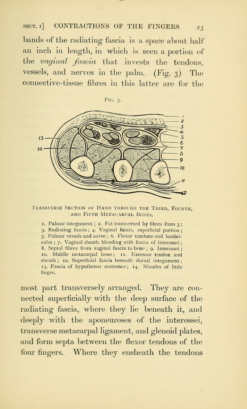 bands of the radiating fascia is a space about half an inch in length, in which is seen a portion of the vaginal fascia that invests the tendons, vessels, and nerves in the palm. (Fig. 3) The connective-tissue fibres in this latter are for the Fig. 3. Transverse Section of Hand through the Third, Fourth, AND Fifth Metacarpal Bones. I. Palmar integument ; 2. Fat transversed by fibres from 3 ; 3. Radiating fascia; 4. Vaginal fascia, superficial portion ; 5. Palmar vessels and nerve ; 6. Flexor tendons and lumbri- cales ; 7. Vaginal sheath blending with fascia of interossei; 8. Septal fibres from vaginal fascia to bone ; 9. Interossei; 10. Middle metacarpal bone; 11. Extensor tendon and sheath ; 12. Superficial fascia beneath dorsal integument; 13. Fascia of hypothenar eminence; 14. Muscles of little finger. most part transversely arranged. They are con- nected superficially with the deep surface of the radiating fascia, where they lie beneath it, and deejDly with the aponeuroses of the interossei, transverse metacarpal ligament, and glenoid plates, and form septa between the flexor tendons of the four fingers. Where they ensheath the tendons