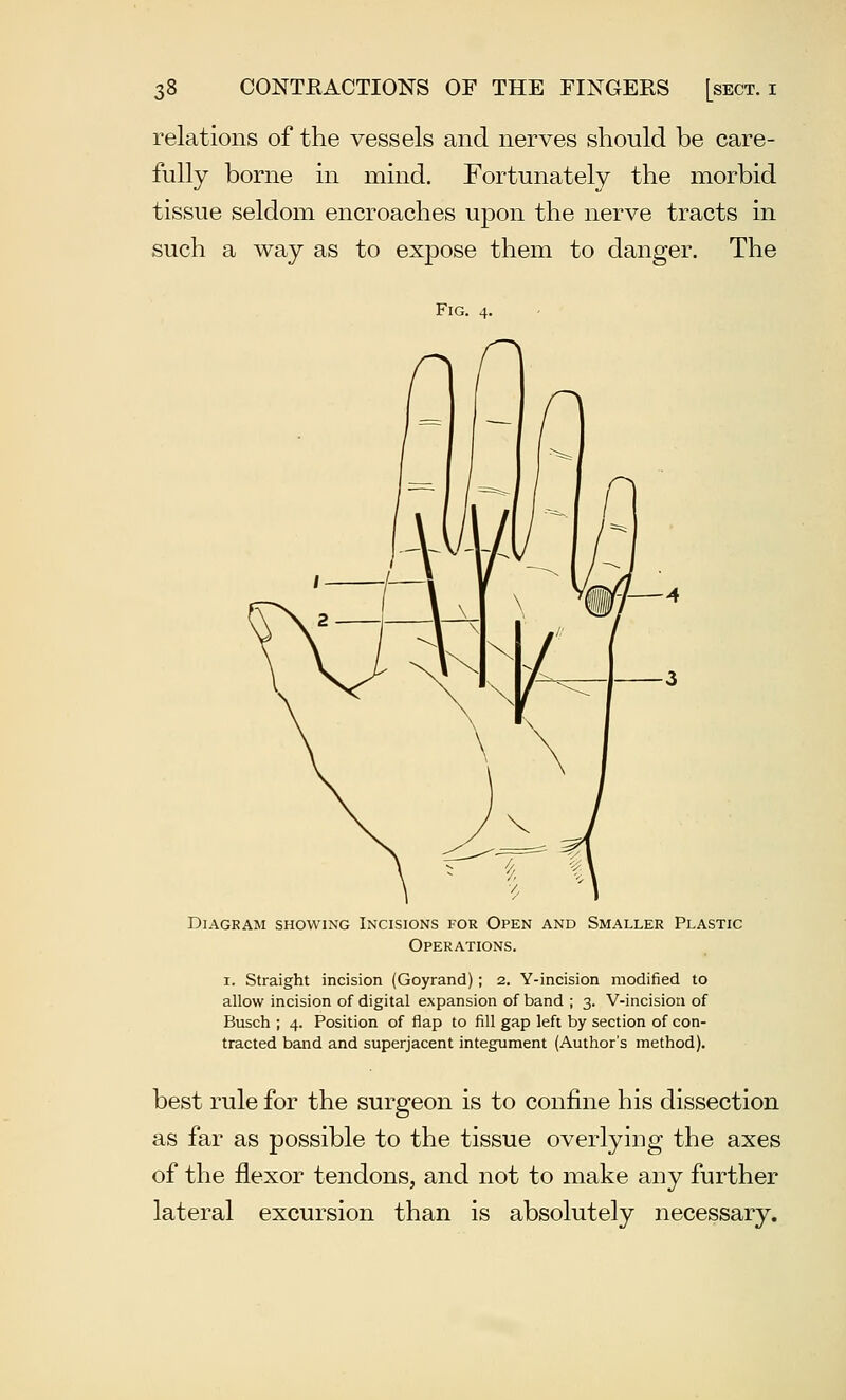 relations of the vessels and nerves should be care- fully borne in mind. Fortunately the morbid tissue seldom encroaches upon the nerve tracts in such a way as to expose them to danger. The Fig. 4. Diagram showing Incisions for Open and Smaller Plastic Operations. 1. Straight incision (Goyrand) ; 2. Y-incision modified to allow incision of digital expansion of band ; 3. V-incisioti of Busch ; 4. Position of flap to fill gap left by section of con- tracted band and superjacent integument (Author's method). best rule for the surgeon is to confine his dissection as far as possible to the tissue overlying the axes of the flexor tendons, and not to make any further lateral excursion than is absolutely necessary.