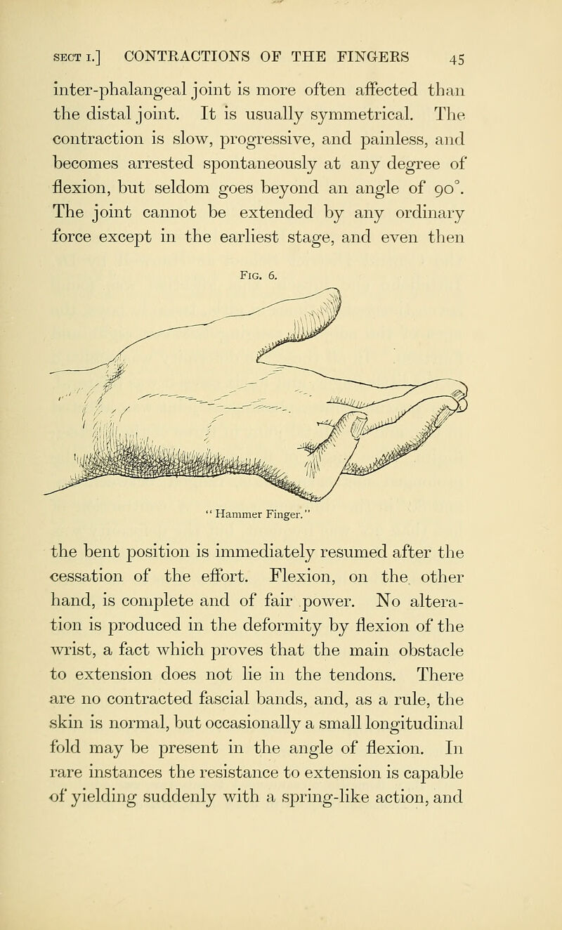 inter-phalangeal joint is more often affected than the distal joint. It is usually symmetrical. The contraction is slow, progressive, and painless, and becomes arrested spontaneously at any degree of flexion, but seldom goes beyond an angle of 90^. The joint cannot be extended by any ordinary force except in the earliest stage, and even then Fig. 6.  Hammer Finger. the bent position is immediately resumed after the cessation of the effort. Flexion, on the other hand, is complete and of fair power. No altera- tion is produced in the deformity by flexion of the wrist, a fact which proves that the main obstacle to extension does not lie in the tendons. There are no contracted fascial bands, and, as a rule, the skin is normal, but occasionally a small longitudinal fold may be present in the angle of flexion. In rare instances the resistance to extension is capable ■of yielding suddenly with a spring-like action, and