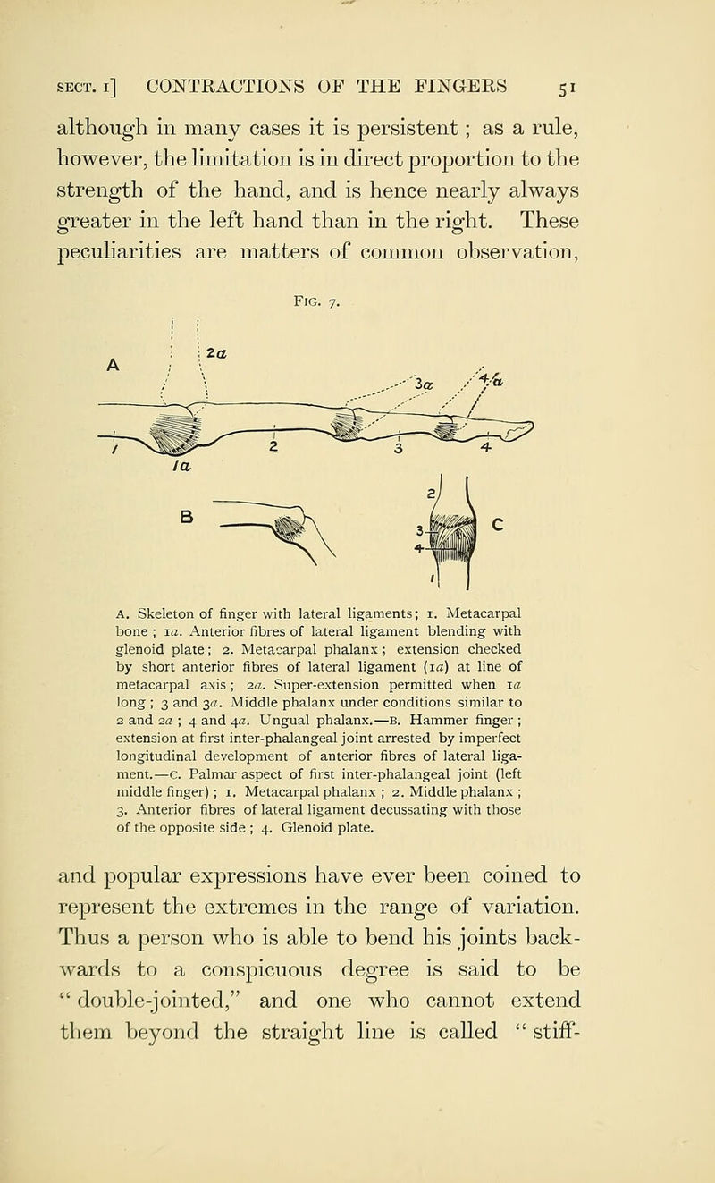 although in many cases it is persistent; as a rule, however, the limitation is in direct proportion to the strength of the hand, and is hence nearly always ofreater in the left hand than in the rio-ht. These peculiarities are matters of common observation, Fig. 7. A. Skeleton of finger with lateral ligaments; i. Metacarpal bone ; la. Anterior fibres of lateral ligament blending with glenoid plate; 2. Metacarpal phalanx; extension checked by short anterior fibres of lateral ligament {la) at line of metacarpal axis ; 2a. Super-extension permitted when za long ; 3 and 3a. Middle phalanx under conditions similar to 2 and za ; 4 and 4a. Ungual phalanx.—B. Hammer finger ; extension at first inter-phalangeal joint arrested by imperfect longitudinal development of anterior fibres of lateral liga- ment.—C. Palmar aspect of first inter-phalangeal joint (left middle finger) ; i. Metacarpal phalanx ; 2. Middle phalanx ; 3. Anterior fibres of lateral ligament decussating with those of the opposite side ; 4. Glenoid plate. and popular expressions have ever been coined to represent the extremes in the range of variation. Thus a person who is able to bend his joints back- wards to a conspicuous degree is said to be  double-jointed, and one who cannot extend them beyond the straight line is called  stiff-