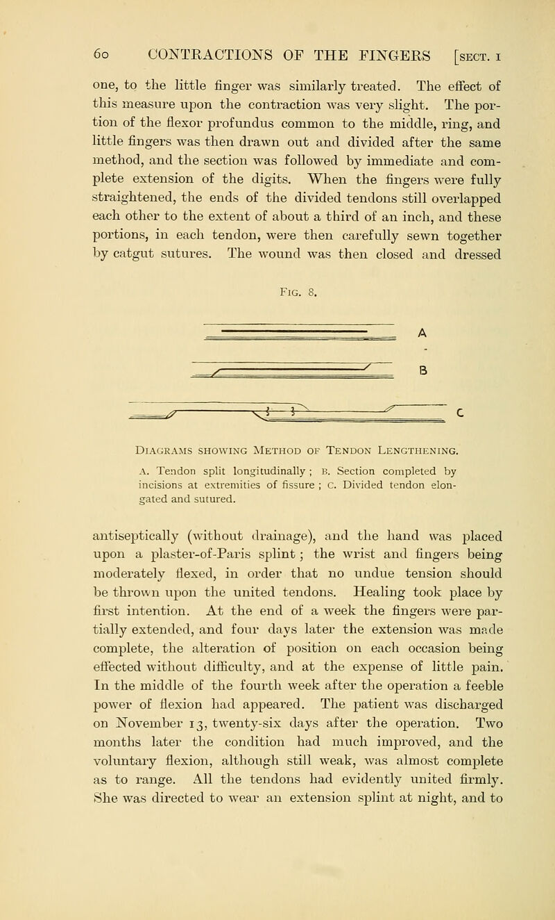 one, to the little finger was similarly treated. The effect of this measure upon the contraction was very slight. The por- tion of the flexor profundus common to the middle, ring, and little fingers was then drawn out and divided after the same method, and the section was followed by immediate and com- plete extension of the digits. When the fingers were fully straightened, the ends of the divided tendons still overlapped each other to the extent of about a third of an inch, and these portions, in each tendon, were then carefully sewn together by catgvit sutures. The wound was then closed and dressed Fig. 8. ^-^ ^ Diagrams showing Method of Tendon Lengthening. A. Tendon split longitudinally ; B. Section completed by incisions at extremities of fissure ; c. Divided tendon elon- s;ated and sutured. antiseptically (without drainage), and the hand was placed upon a plaster-of-Paris splint; the wrist and fingers being moderately flexed, in order that no undue tension should be thrown upon the united tendons. Healing took place by first intention. At the end of a week the fingers were par- tially extended, and four days later the extension was made complete, the alteration of position on each occasion being effected without difiiculty, and at the expense of little pain. In the middle of the fourth week after the operation a feeble power of flexion had appeared. The patient was discharged on November 13, twenty-six days after the operation. Two months later the condition had much improved, and the voluntary flexion, although still weak, was almost complete as to range. All the tendons had evidently united firmly. She was directed to wear an extension splint at night, and to