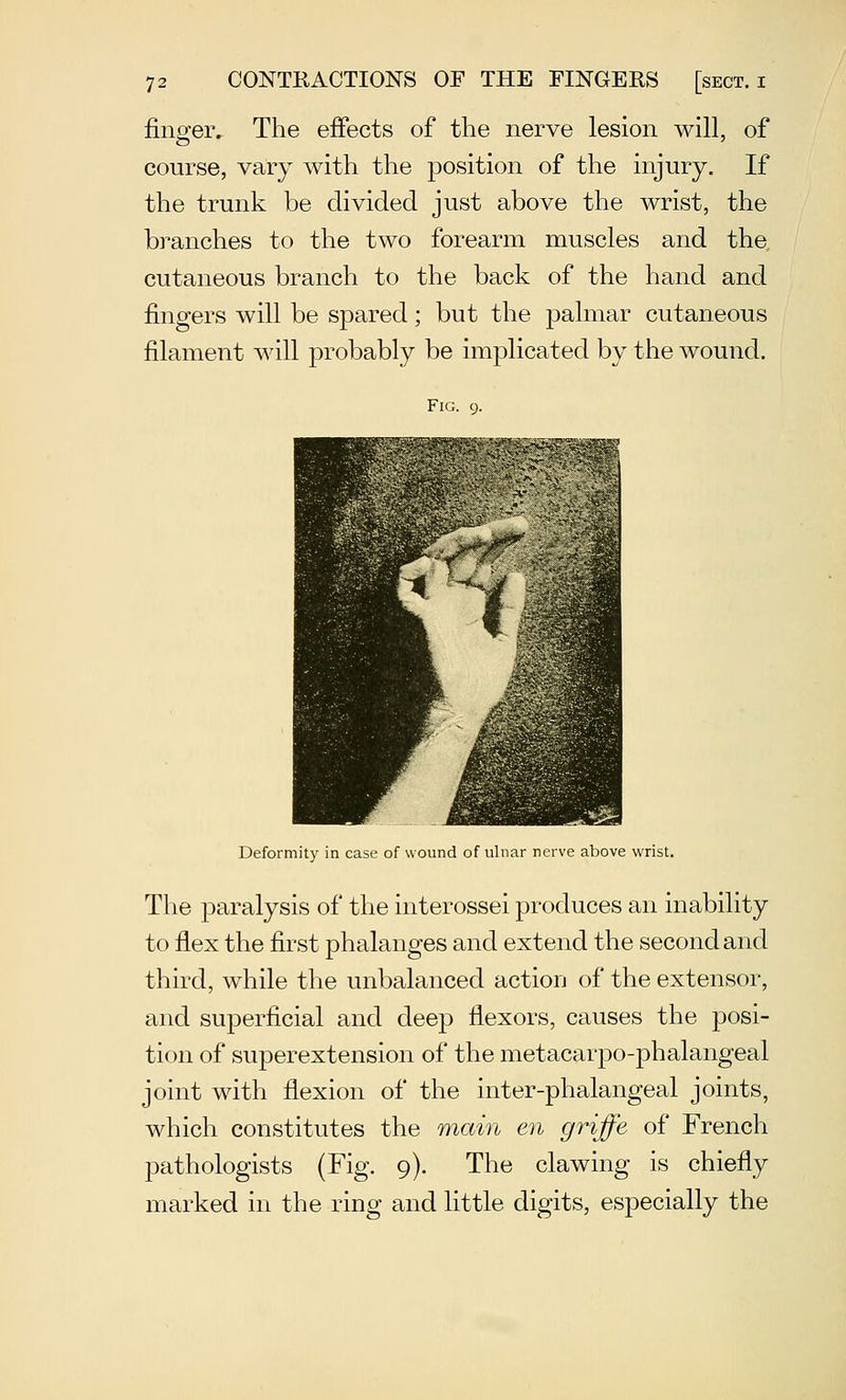 finger. The effects of the nerve lesion will, of course, vary with the position of the injury. If the trunk be divided just above the wrist, the branches to the two forearm muscles and the cutaneous branch to the back of the hand and fingers will be spared; but the palmar cutaneous filament will probably be implicated by the wound. Fig. 9. Deformity in case of wound of ulnar nerve above wrist. The paralysis of the interossei produces an inability to flex the first phalanges and extend the second and third, while the unbalanced action of the extensor, and superficial and deep flexors, causes the posi- tion of superextension of the metacarpo-phalangeal joint with flexion of the inter-phalangeal joints, which constitutes the main en griffe of French pathologists (Fig. 9). The clawing is chiefly marked in the ring and little digits, especially the