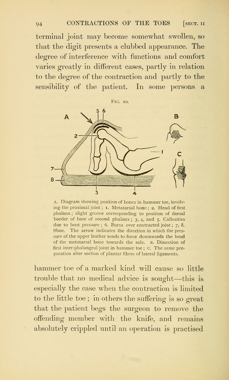 terminal joint may become somewhat swollen, so that the digit presents a clubbed appearance. The degree of interference with functions and comfort varies greatly in different cases, partly in relation to the degree of the contraction and partly to the sensibility of the patient. In some persons a Fig. 10. A. Diagram showing position of bones in hammer toe, involv- ing the proximal joint ; I. Metatarsal bone ; 2. Head of first phalanx ; slight groove corresponding to position of dorsal border of base of second phalanx ; 3, 4, and 5. Callosities due to boot pressure ; 6. Bursa over contracted joint; 7, 8. Shoe. The arrow indicates the direction in which the pres- sure of the upper leather tends to force downwards the head of the metatarsal bone towards the sole. B. Dissection of first inter-phalangeal joint in hammer toe ; C. The same pre- paration after section of plantar fibres of lateral ligaments. hammer toe of a marked kind will cause so little trouble that no medical advice is sought—this is especially the case when the contraction is limited to the little toe ; in others the suffering is so great that the patient begs the surgeon to remove the offending member with the knife, and remains absolutely crippled until an operation is practised
