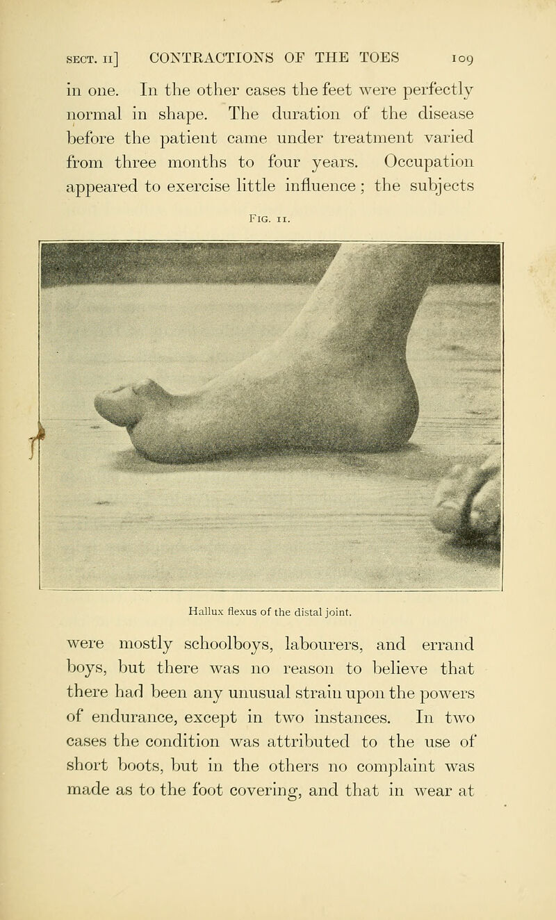 in one. In the other cases the feet were perfectly normal m shape. The duration of the disease before the patient came under treatment varied from three months to four years. Occupation appeared to exercise little influence ; the subjects Fig. II. Hallux flexus of the distal joint. were mostly schoolboys, labourers, and errand boys, but there was no reason to believe that there had been any unusual strain upon the powers of endurance, except in two instances. In two cases the condition was attributed to the use of short boots, but in the others no complaint was made as to the foot covering, and that in wear at